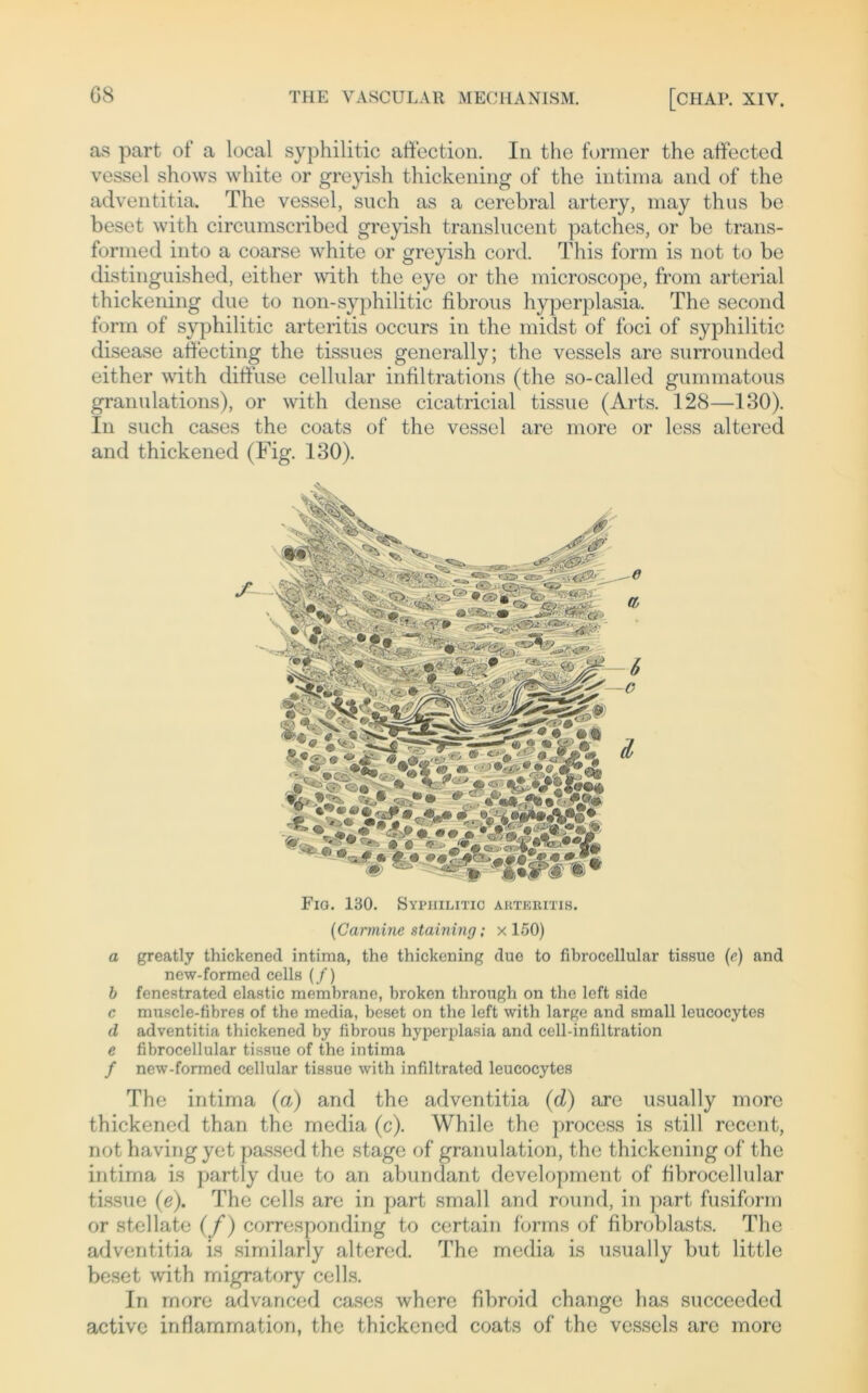 as part of a local syphilitic affection. In the furnier the affected vessel shows white or greyish thickening of the intima and of the adventitia. The vessel, such as a cerebral artery, may thus be beset with circumscribed greyish translucent patches, or be trans- formed into a coarse white or greyish cord. This form is not to be distinguished, either with the eye or the microscope, from arterial thickening due to non-syphilitic fibrous hyperplasia. The second form of syphilitic arteritis occurs in the midst of foci of syphilitic disease affecting the tissues generally; the vessels are surrounded either with diffuse cellular infiltrations (the so-called gummatous granulations), or with dense cicatricial tissue (Arts. 128—130). In such cases the coats of the vessel are more or less altered and thickened (Fig. 130). f Fio. 130. Syphilitic auteritis. {Carmine staining; x 150) a greatly thickened intima, the thickening due to fibrocellular tissue (c) and new-formed cells (/) b fenestrated elastic membrane, broken through on the left side c muscle-fibres of the media, beset on the left with large and small leucocytes d adventitia thickened by fibrous hyperplasia and cell-infiltration e fibrocellular tissue of the intima / new-formed cellular tissue with infiltrated leucocytes The intima (a) and the adventitia (d) are usually more thickened than the media (c). While the process is still recent, not havingyet passed the stage of granulation, the thickening of the intima is partly due to an abundant development of fibrocellular tissue (e). The cells are in part small and round, in part fusiform or stellate (/) corresponding to certain forms of fibroblasts. The adventitia is similarly altercd. The media is usually but little beset with migratory cells. In more advanced cases where fibroid change has succeeded active inflammation, the thickened coats of the vessels are more