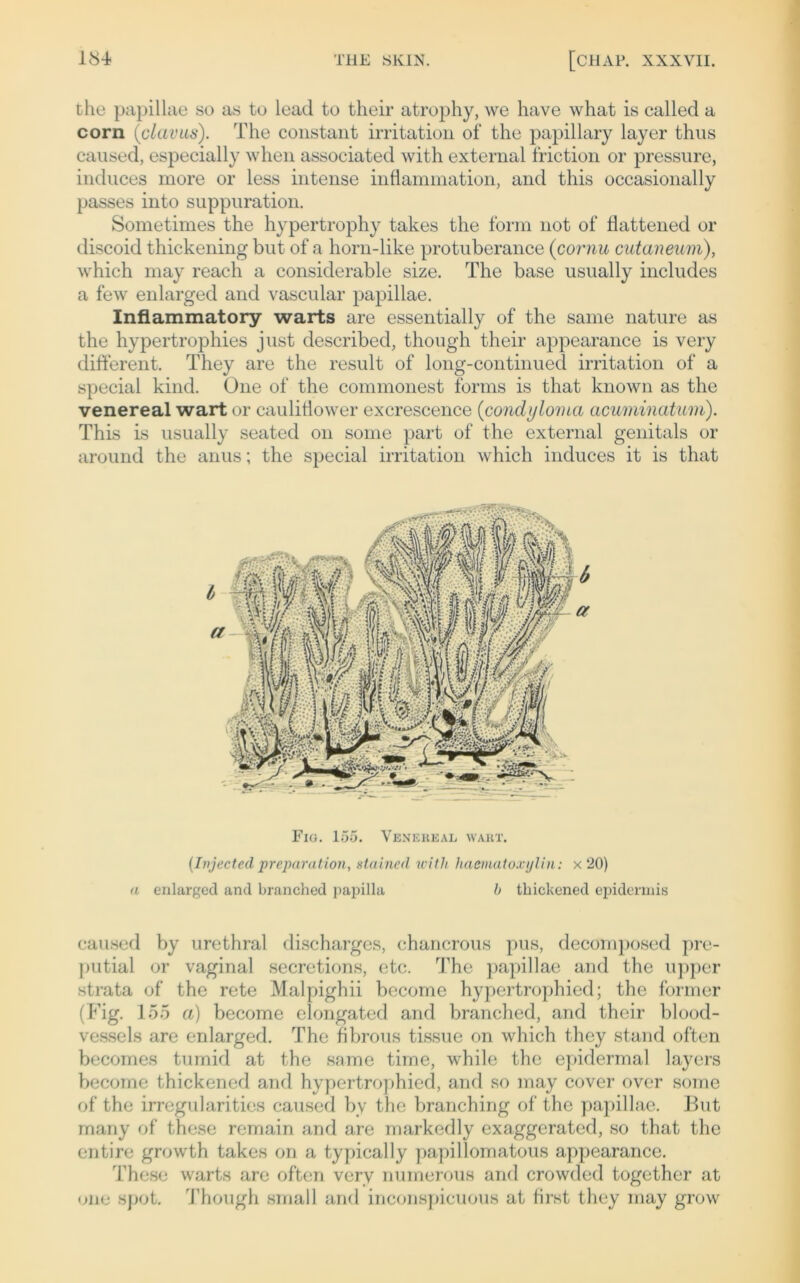 the papillae so as to lead tu their atrophy, we have what is called a corn (clavus). The constant irritation of the papillary layer thus caused, especially when associated with external friction or pressure, induces more or less intense inflammation, and this occasionally passes into suppuration. Sometimes the hypertrophy takes the form 110t of liattened or discoid thickening but of a horn-like protuberance (cornu cutaneum), which may reach a considerable size. The base usually includes a few enlarged and vascular papillae. Inflammatory warts are essentially of the same nature as the hypertrophies just described, though their appearance is very different. They are the result of long-continued irritation of a special kind. One of the commonest forms is that known as the venereal wart or cauliflower excrescence (condyloma acuminatum). This is usually seated on some part of the external genitals or around the anus; the special irritation which induces it is that Fio. 155. Venereal wart. (Injectecl preparation, staincd with hacmatoxylin: x 20) a enlarged and branched papilla b thickened epidermis caused by urethral discharges, chancrous pus, decomposed pre- putial or vaginal secretions, etc. The papillae and the upper strata of the rete Malpighii becorne hypertrophied; the former (Fig. 155 a) become elongated and branched, and their blood- vessels are enlarged. The fibrous tissue on which they stand often becomes tumid at the same time, while the epidermal layers become thickened and hypertrophied, and so may cover over some of the irregularities caused by the branching of the papillae. But many of these remain and are markedly exaggerated, so that the entire growth takes on a typically papillomatous appearance. These warts are often verv numerous and crowded together at one spot. Though small and inconspicuous at first they may grow