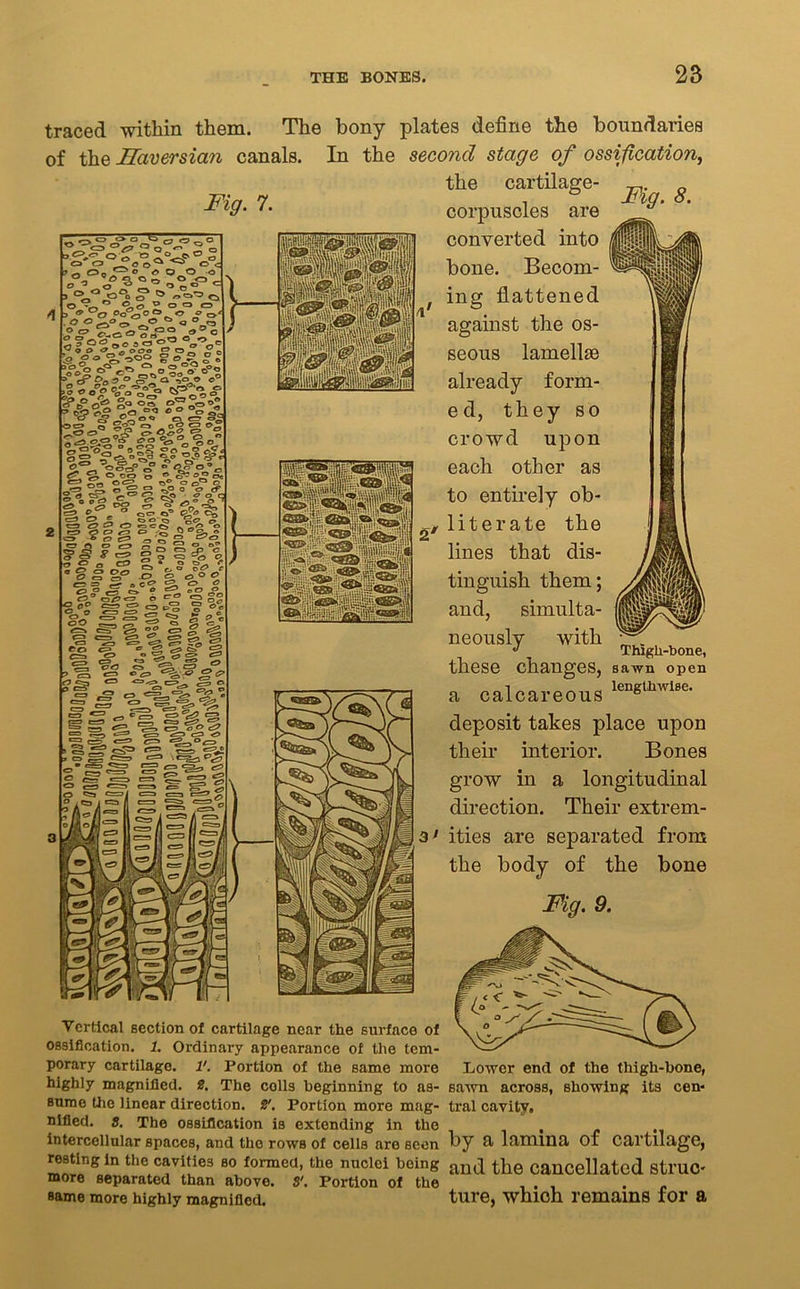 traced within them. The bony plates define the boundaries of the Haversian canals. In the second stage of ossification, the cartilage- Fig. 7. . Fig. 8. corpuscles are converted into bone. Becom- ing flattened against the os- seous lamellse already form- ed, they so crowd upon each other as to entirely ob- literate the lines that dis- tinguish them; and, simulta- neously with these changes, sawn open a calcareous lengUlwi8e' deposit takes place upon their interior. Bones grow in a longitudinal direction. Their extrem- ities are separated from the body of the bone Fig. 9. Thigh-bone, Vertical section of cartilage near the surface of ossification. 1. Ordinary appearance of the tem- porary cartilage. V. Portion of the same more highly magnified. 2, The colls beginning to as- sume the linear direction. 2'. Portion more mag- nified. s. The ossification is extending in the intercellular spaces, and the rows of cells are seen resting in the cavities so formed, the nuclei boing more separated than above. S'. Portion of the same more highly magnified. Lower end of the thigh-bone, sawn across, showing its cen- tral cavity. by a lamina of cartilage, and the cancellated struc- ture, whioh remains for a