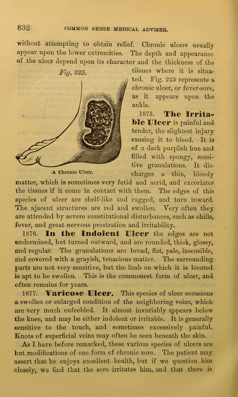 without attempting to obtain relief. Chronic ulcers usually appear upon the lower extremities. The depth and appearance of the ulcer depend upon its character and the thickness of the Fig. 225. tissues where it is situa- ted. Fig. 225 represents a chronic ulcer, or fever-sore, as it appears upon the ankle. 1875. The Irrita- ble Ulcer is painful and tender, the slightest injury causing it to bleed. It is of a dark purplish hue and filled with spongy, sensi- tive granulations. It dis- a chrome ulcer. charges a thin, bloody matter, which is sometimes very fetid and acrid, and excoriates the tissues if it come in contact with them. The edges of this species of ulcer are shelf-like and ragged, and turn inward. The ajacent structures are red and swollen. Very often they are attended by severe constitutional disturbances, such as chills, fever, and great nervous prostration and irritability. 1876. In the Indolent Ulcer the edges are not undermined, but turned outward, and are rounded, thick, glossy, and regular. The granulations are broad, flat, pale, insensible, and covered with a grayish, tenacious matter. The surrounding parts are not very sensitive, but the limb on which it is located is apt to be swollen. This is the commonest form of ulcer, and often remains for years. 1877. Varicose Ulcer. This species of ulcer occasions a swollen or enlarged condition of the neighboring veins, which are very much enfeebled. It almost invariably appears below the knee, and may be either indolent or irritable. It is generally sensitive to the touch, and sometimes excessively painful. Knots of superficial veins may often be seen beneath the skin. As I have before remarked, these various species of ulcers arc but modifications of one form of chronic sore. The patient may assert that he enjoys excellent health, but if we question him closely, we find that the sore irritates him, and that there is