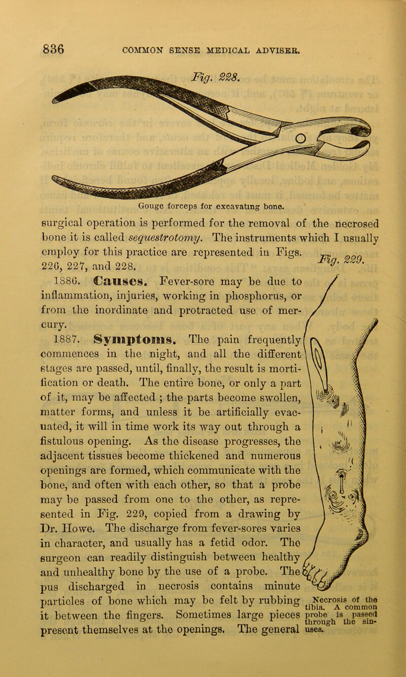 Gouge forceps for excavating bone. Fig. 229. surgical operation is performed for the removal of the necrosed bone it is called sequestrotomy. The instruments which I usually employ for this practice are represented in Figs. 220, 227, and 228. 1880. Causes. Fever-sore may be due to inflammation, injuries, working in phosphorus, or from the inordinate and protracted use of mer- cury. 1887. Symptoms. The pain frequently commences in the night, and all the different stages are passed, until, finally, the result is morti- fication or death. The entire bone, or only a part of it, may be affected ; the parts become swollen, matter forms, and unless it be artificially evac- uated, it will in time work its way out through a fistulous opening. As the disease progresses, the adjacent tissues become thickened and numerous openings are formed, which communicate with the bone, and often with each other, so that a probe may be passed from one to the other, as repre- sented in Fig. 229, copied from a drawing by Dr. Howe. The discharge from fever-sores varies in character, and usually has a fetid odor. Tho surgeon can readily distinguish between healthy and unhealthy bone by the use of a probe. The pus discharged in necrosis contains minute particles of bone which may be felt by rubbing it between the fingers. Sometimes large pieces probe is passed ° . mi through the sm- present themselves at the openings, lhe general uses. Necrosis of the tibia. A common