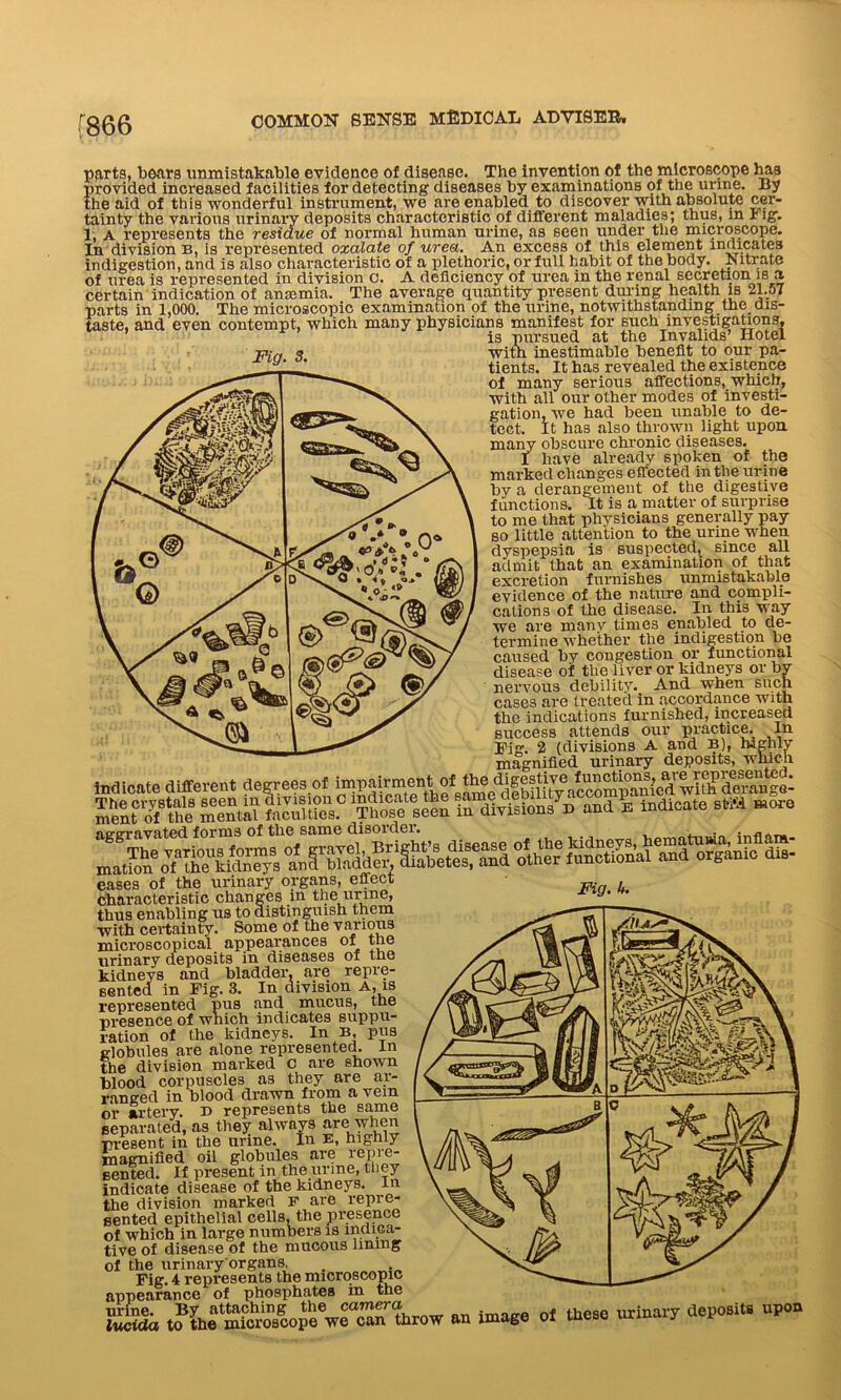 [866 parts, bears unmistakable evidence of disease. The invention of the microscope has provided increased facilities for detecting diseases by examinations 9* urine. By 4-lir. nid /\< 1 in ofvn m tiro OVA DTI ClVlIofl fll^P.OVPV Wlfll JinflOllltft X. Jt\. ICUieOtlllD LIAO / OOIUH/O \JA 1IU1UJWA U11UU) 110 V'' _ y . , 4. * T 4 In division B, is represented oxalate of urea. An excess of this element inflicates indigestion, and is also characteristic of a plethoric, or full habit of the body. Nitrate of urea is represented in division c. A deficiency of urea in the renal secretion is a certain indication of anrnmia. The average quantity present during health is 21.57 parts in 1,000. The microscopic examination of the urine, notwithstanding the dis- taste, and even contempt, which many physicians manifest for such investigations, ’ is pursued at the Invalids’ Hotel p;n 9 with inestimable benefit to our pa- y' ' tients. It has revealed the existence of many serious affections, which, with all our other modes of investi- gation, we had been unable to de- tect. It has also thrown light upon many obscure chronic diseases. I have already spoken of the marked changes effected in the urine by a derangement of the digestive functions. It is a matter of surprise to me that physicians generally pay so little attention to the urine when dyspepsia is suspected, since all admit that an examination of that excretion furnishes unmistakable evidence of the nature and compli- cations of the disease. In this 'way we are many times enabled to de- termine whether the indigestion be caused by congestion or functional disease of the liver or kidneys or by nervous debility. And when such cases are treated in accordance with the indications furnished, increased success attends our practice.. In Pig. 2 (divisions A and B), highly magnified urinary deposits, which eases of the urinary organs, effect characteristic changes in the urine, thus enabling us to distinguish them with certainty. Some of the various microscopical appearances of the urinary deposits in diseases of the kidneys and bladder, are repre- sented in Fig. 3. In division A, is represented pus and mucus, tne presence of which indicates suppu- ration of the kidneys. In B, pus globules are alone represented. In the division marked c are shown blood corpuscles as they are ar- ranged in blood drawn from a vein or artery. x> represents the same separated, as they always are when present in the urine. In E, highly magnified oil globules are repre- sented. If present in the urine, they indicate disease of the kidneys, in the division marked F are repre- sented epithelial cells, the presence of which in large numbers is indica- tive of disease of the mucous lining of the urinary'organs, . Fig. 4 represents the microscopic appearance of phosphates in the urine. By attaching the camera lucida to the microscope we can throw an image of these urinary deposits upon