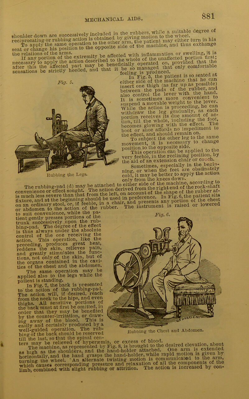 .houlte down are reciprocating or rubbing action is obtame > | tl°e patient may either turn m his ra‘l *1,,“ *• .w ^ necessary to apply the action desciibecl operated on, provided that the after this the affected par- may be Jen£fl£ia1^ managed that only comfortable sensations be strictly heeded, and that it je bo ma ° duce(L In Fig. o, the patient is so seated at either side of the machine that he can insert one thigh (as far up as possible) between the pads of the rubbei, and also control the lever with the hand. Ti is sometimes more convenient to suspend a movable weight to the lever. While the action is proceeding, he can withdraw the leg gradually, as each portion receives its due amount of ac- tion, till the whole, including the foot, becomes glowing with the effect. Ihe boot or shoe affords no impediment to the effect, and should remain on. To subject the other leg to the same movement, it is necessary to change position to the opposite side. , ,, 1 This operation can be applied to the verv feeble, in the reclining position, by the aid of an extension chair or couch. Sometimes, especially in the begin- ning, or when the feet are obstinately colcl, it may be better to apply the action only from the knees down. The rubbing-pad (d) may fixture, and at the beginning should be used ^ ^rt{on 0f the chest “ ^gSSZVO^ of ie SASTlSffflSm-. tf .aised « lowered Fig Kubbing tlie Legs Fig. 6. to suit convenience, while the pa- tient gently presses portions of the trunk successively upon the rub- bing-pad. The degree of the effect is thus always under the absolute control of the one receiving the action. This operation, like the preceding, produces great heat, reddens the skin, relieves pain, and greatly stimulates the func- tions, not only of the skin, but of the organs contained in the cavi- ties of the chest and the abdomen. The same operation may be applied also to the legs while the patient is standing. In Fig. 7, the back is presented to the action of the rubbing-pad. The action will, if desired, reach from the neck to the hips, and even thighs. All sensitive portions of the back must at first be omitted, in order that they may be benefited by the counter-irritation, or draw- in0- away of the blood. This is easily and certainly produced by a well-guided operation. The rub- bing of the back should be reserved till the last, so that the Bpinal cen- tprs mav be relieved of hyperaimia, or excess of bioon. . .. f The machine, as represented by Fig. 8, is hrought to the ^sircd elcvation^ a io as high as the shoulders, and the hand-holder attached. One aini• horizontally, and the hand grasps the hand-holder, while rapid niotion is given liy turning the wheel. ’ An alternate twisting motion is communicated to the ai m, which cause# corresponding pressure and relaxation of all the components of the limb combined with slight rubbing or attrition. The action is increased b> con- llubbing llie Chest and Abdomen.