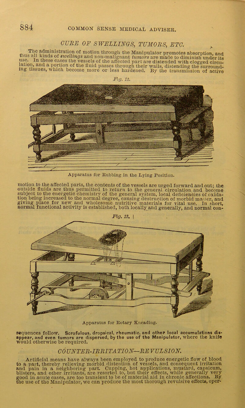 CURE OF SWELLINGS, TUMORS, ETC. TjVr ^ministration of motion through the Manipulator promotes absorption, and taus all hinds of swellings and non-malignant tumors are made to diminish under its use. in these cases the vessels of the affected part are distended with clogged circu- lation, and a portion of the fluid passes through their walls, distending the surround- ing tissues, which become more or less hardened. By the transmission of active Fig. 12. Apparatus for Bubbing in the Lying Position. motion to the affected parts, the contents of the vessels are urged forward and out; the outside fluids are thus permitted to return to the general circulation and become subject to the energetic chemistry of the general system, local deficiencies of oxida- tion being increased to the normal degree, causing destruction of morbid mailer, and giving place for new and wholespme nutritive materials for vital use. In short, normal functional activity is established, both locally^and generally, and normal con- Ftg. 13. ! Apparatus for Eotary Kneading. sequences follow. Scrofulous, dropsical, rheumatic, and other local accumulations dis- appear, and even tumors are dispersed, by the use of the Manipulator, where the knife would otherwise be required. CO UNTER-IRRITA TION—RE VULSION. Artificial means have always been employed to produce energetic flow of blood to a part, thereby relieving morbid distention of vessels, and consequent irritation and pain in a neighboring part. Cupping, hot applications, mustard, capsicum, blisters, and other irritants, are resorted to, but their effects, while generally very good in acute cases, are too transient to be of material aid in chronic affections. By the use of the Manipulator, wo can produce the most thorough revulsivo effects, oper-