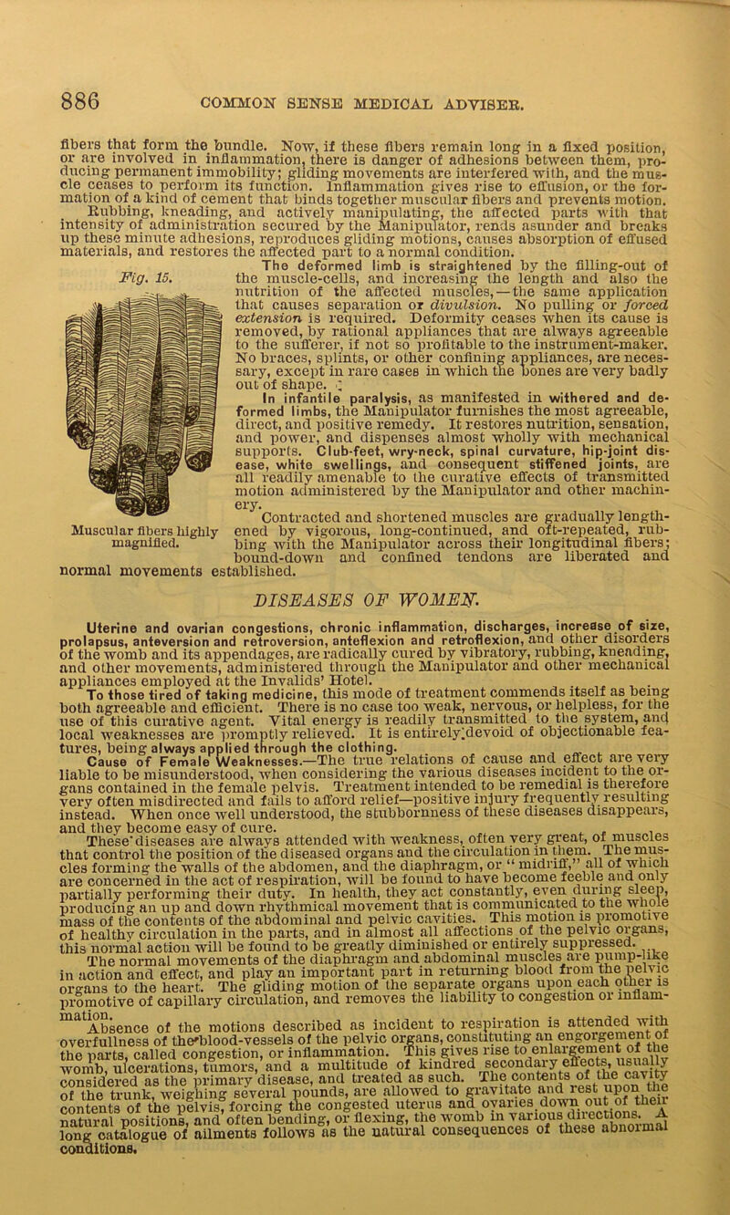 fibers that form the bundle. Now, if these fibers remain long in a fixed position, or are involved in inflammation, there is danger of adhesions between them, pro- ducing permanent immobility; gliding movements are interfered with, and the mug- nnofina frv i il • - „ . • a \ r cle ceases to perform its function. Inflammation gives rise to effusion, or the for- up these minute adhesions, reproduces gliding motions, causes absorption of effused materials, and restores the affected part to a normal condition. The deformed limb is straightened by the filling-out of Fig. 15. the muscle-cells, and increasing the length and also the nutrition of the affected muscles, — the same application that causes separation or divulsion. No pulling or forced extension is required. Deformity ceases when its cause is removed, by rational appliances that are always agreeable to the sufferer, if not so profitable to the instrument-maker. No braces, splints, or other confining appliances, are neces- sary, except in rare caseB in which the bones are very badly out of shape. •; In infantile paralysis, as manifested in withered and de- formed limbs, the Manipulator furnishes the most agreeable, direct, and positive remedy. It restores nutrition, sensation, and power, and dispenses almost wholly with mechanical supports. Club-feet, wry-neck, spinal curvature, hip-joint dis- ease, white swellings, and consequent stiffened joints, are all readily amenable to the curative effects of transmitted motion administered by the Manipulator and other machin- ery. Contracted and shortened muscles are gradually length- ened by vigorous, long-continued, and oft-repeated, rub- bing with the Manipulator across their longitudinal fibers; bound-down and confined tendons are liberated and established. DISEASES OF WOMEN. Uterine and ovarian congestions, chronic inflammation, discharges, increase of size, prolapsus, anteversion and retroversion, anteflexion and retroflexion, and other disorders of the womb and its appendages, are radically cured by vibratory, rubbing, kneading, and other movements, administered through the Manipulator and other mechanical appliances employed at the Invalids’ Hotel. . To those tired of taking medicine, this mode of treatment commends itself as being both agreeable and efficient. There is no case too weak, nervous, or helpless, for the use of this curative agent. Vital energy is readily transmitted to the system, and local weaknesses are promptly relieved. It is entirely^ evoid of objectionable fea- tures, being always applied through the clothing. Cause of Female Weaknesses.—The true relations of cause and effect are very liable to be misunderstood, when considering the various diseases incident to the or- gans contained in the female pelvis. Treatment intended to be remedial is therefore very often misdirected and fails to afford relief—positive injury frequently resulting instead. When once well understood, the stubbornness of these diseases disappears, and they become easy of cure. These'diseases are always attended with weakness, often very great, of muscles that control the position of the diseased organs and the circulation in them. The mus- cles forming the walls of the abdomen, anu the diaphragm, or “ midriff, all of which are concerned in the act of respiration, will be found to have become feeble and only ,, i1Qnifh apt p.rvnHtn.ntlv. even during sleep. Muscular fibers highly magnified. normal movements w vw_ v,w- — w — j. *ulUDj lV 111 t/U lv/uii v-*. vw “ partially performing their duty. In health, they act constantly, even during sleep, producing an up and down rhythmical movement that is communicated to the whole mass of the contents of the abdominal and pelvic cavities. This motion is promotive of healthy circulation in the parts, and in almost all affections of the pelvic organs, this normal action will be found to be greatly diminished or entirely suppressed. The normal movements of the diaphragm and abdominal muscles are pump-like in action and effect, and play an important part in returning blood from the pelyic organs to the heart. The gliding motion of the separate organs upon each othei is pro motive of capillary circulation, and removes the liability to congestion 01 mnam- ma Absence of the motions described as incident to respiration is attended with overfullness of thefiflood-vessels of the pelvic organs, constituting an the parts, called congestion, or inflammation. This gives rise to. eniaigement of the womb, ulcerations, tumors, and a multitude of kindred secondary eflfects, usually considered as the primary disease, and treated as such. The contents of the cavity o? the teunkfwei^K several pounds, are allowed to gravitate and rest upon the contents of the pelvis, forcing the congested uterus and ovaries down out of then natural positions, and often bending, or flexing, the womb in various directions A long catalogue of ailments follows as the natural consequences of these abnoimai iditions. con