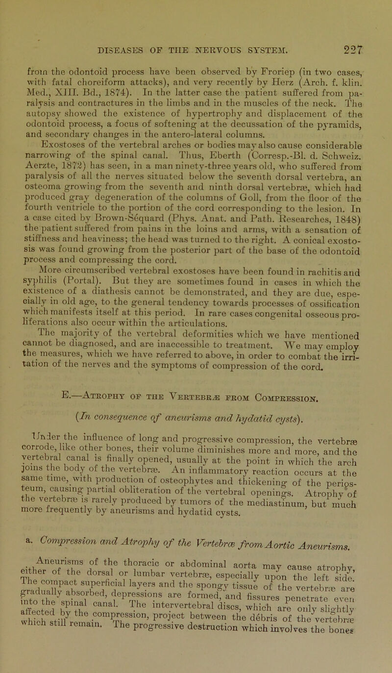 from the odontoid process have been observed by Froriep (in two cases, with fatal choreiform attacks), and very recently by Herz (Arch. f. klin. Med., XIII. Bd., 1874). In the latter case the patient suffered from pa- ralysis and contractures in the limbs and in the muscles of the neck. The autopsy showed the existence of hypertrophy and displacement of the odontoid process, a focus of softening at the decussation of the pyramids, and secondary changes in the antero-lateral columns. Exostoses of the vertebral arches or bodies may also cause considerable narrowing of the spinal canal. Thus, Eberth (Corresp.-Bl. d. Schweiz. Aerzte, 1872) has seen, in a man ninety-three years old, who suffered from paralysis of all the nerves situated below the seventh dorsal vertebra, an osteoma growing from the seventh and ninth dorsal vertebrm, which had produced gray degeneration of the columns of Goll, from the floor of the fourth ventricle to the portion of the cord corresponding to the lesion. In a case cited by Brown-Sequard (Phys. Anat. and Path. Researches, 1848) the patient suffered from pains in the loins and arms, with a Sensation of stiffness and heaviness; the head was turned to the right. A conical exosto- sis was found growing from the posterior part of the base of the odontoid process and compressing the cord. More circumscribed vertebral exostoses have been found in rachitis and Syphilis (Portal). But they are sometiines found in cases in which the existence of a diathesis cannot be demonstrated, and they are due, espe- cially in old age, to the general tendeney towards processes of ossification which manifests itself at this period. In rare cases congenital osseouspro- liferations also occur within the articulations. The majority of the vertebral deformities which we have mentioned cannot be diagnosed, and are inaccessible to treatinent. We may employ the measures, which we have referredto above, in order to combat the irri- tation of the nerves and the Symptoms of compression of the cord. E- Atropiiy of tue Vertebr/e from Compression. (In consequence of ctneurisms and hydatid cysts). Puder the influence of long and progressive compression, the vertebrm corrodelike other bones, their volume diminishes more and more, and the vertebral canal is hnally opened, usually at the point in which the arch joms the body of the vertebrae. An inflammatory reaction occurs at the same time, with production of osteophytes and thickening of the perios- teum, causing partial obliteration of the vertebral openings. Atroph v of the vertebrm is rarely produced by tumors of the mediastinum, but niuch more frequently by aneunsms and hydatid cysts. a. Compression and Atrophy of the Vertebrat fromAortic Aneurisms. eith^Tr f **1® th?rac or abdominal aorta may cause atrophy, either of the dorsal or lumbar vertebne, especially upon the left side The compact superficial layers and the spongy tissue ol^ the vertebre are fnto ÄmAM1'bped’r ePrr!fiors+are f°rmed, and fissures penetrate even uP ln a ' :.he intervertebral discs, which are only slio-htly whibh stüiyremMnmThSS1°n’ Pr°jeCt ^etWeer’ the d6bris of the vertebrm 1 remain- rhe progressive destruction which involves the bones