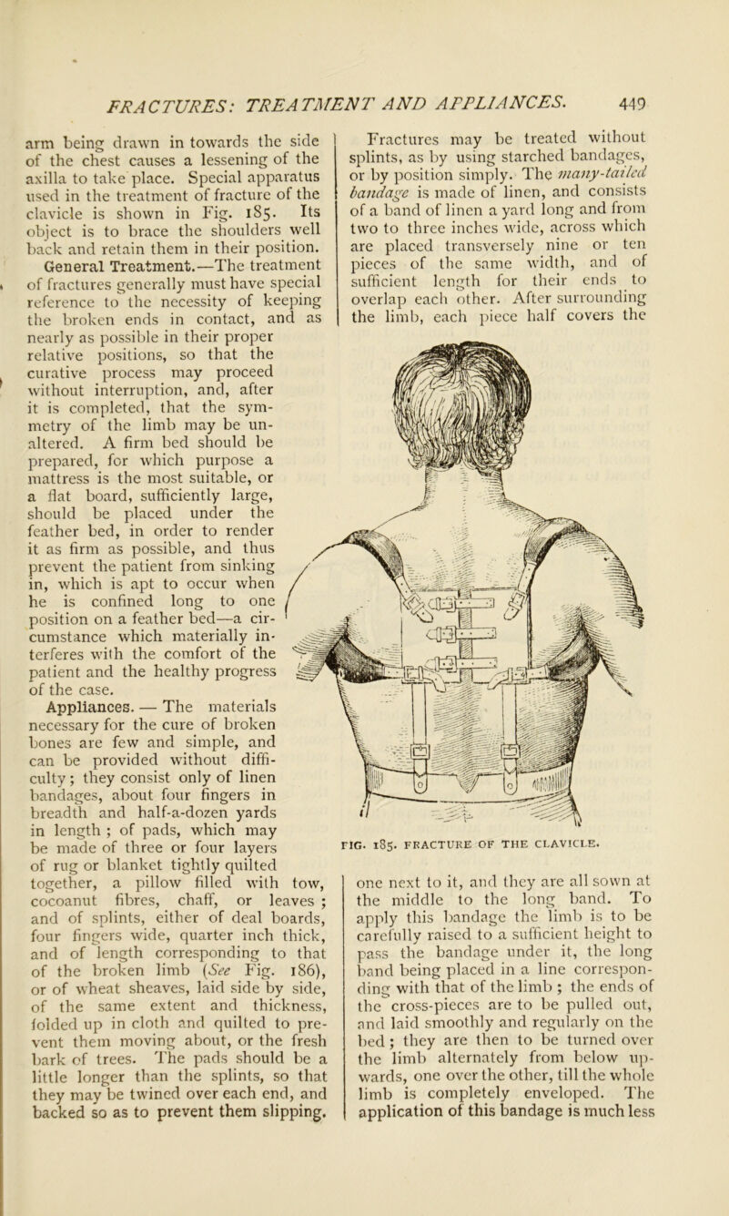 I arm being drawn in towards the side of the chest causes a lessening of the axilla to take place. Special apparatus used in the treatment of fracture of the clavicle is shown in Fig. 185. Its object is to brace the shoulders well back and retain them in their position. General Treatment.—The treatment of fractures generally must have special reference to the necessity of keeping the broken ends in contact, and as nearly as possible in their proper relative positions, so that the curative process may proceed without interruption, and, after it is completed, that the sym- metry of the limb may be un- altered. A firm bed should be prepared, for which purpose a mattress is the most suitable, or a flat board, sufficiently large, should be placed under the feather bed, in order to render it as firm as possible, and thus prevent the patient from sinking in, which is apt to occur when he is confined long to one position on a feather bed—a cir- cumstance which materially in- terferes with the comfort of the patient and the healthy progress of the case. Appliances. — The materials necessary for the cure of broken bones are few and simple, and can be provided without diffi- culty ; they consist only of linen bandages, about four fingers in breadth and half-a-dozen yards in length ; of pads, which may be made of three or four layers of rug or blanket tightly quilted together, a pillow filled with tow, cocoanut fibres, chaff, or leaves ; and of splints, either of deal boards, four fingers wide, quarter inch thick, and of length corresponding to that of the broken limb (See Fig. 186), or of wheat sheaves, laid side by side, of the same extent and thickness, folded up in cloth and quilted to pre- vent them moving about, or the fresh bark of trees. The pads should be a little longer than the splints, so that they may be twined over each end, and backed so as to prevent them slipping. Fractures may be treated without splints, as by using starched bandages, or by position simply. The many-tailed bandage is made of linen, and consists of a band of linen a yard long and from two to three inches wide, across which are placed transversely nine or ten pieces of the same width, and of sufficient length for their ends to overlap each other. After surrounding the limb, each piece half covers the G. 185. FRACTURE OF THE CLAVICLE. one next to it, and they are all sown at the middle to the long band. To apply this bandage the limb is to be carefully raised to a sufficient height to pass the bandage under it, the long band being placed in a line correspon- ding with that of the limb ; the ends of the cross-pieces are to be pulled out, and laid smoothly and regularly on the bed ; they are then to be turned over the limb alternately from below up- wards, one over the other, till the whole limb is completely enveloped. The application of this bandage is much less