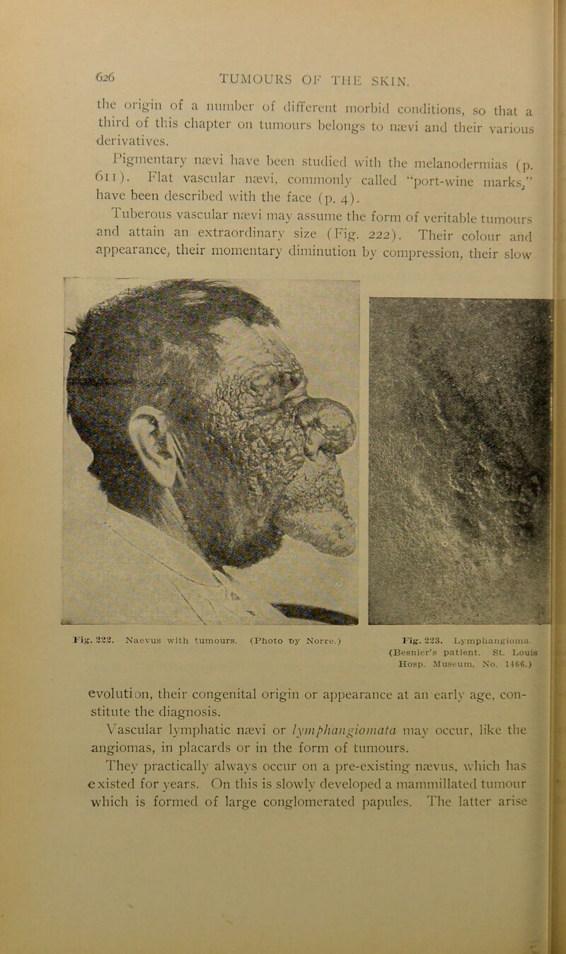 the 01 igin of a number of different morbid conditions, so tlmd of this chapter on tumours belongs to nævi and their dérivatives. that a various Pigmentary nævi bave been stndied vvith the melanodermias (p. 611). Fiat vascular nævi, commonly called “port-wine marks/’ bave been described with the face (p. 4). Tubero.üs vascular nævi may assume the form of véritable tumours and attain an extraordinary size (Fig. 222). Their colour and appearance, their momentary diminution by compression, their slow Fig. 222. Naevus with tumours. (Photo t>y Norre.) Fig. 223. Lympliangioma. (Besnier’s patient. St. Louis Hosp. Muséum, No. 1466.) évolution, their congénital origin or appearance at an early âge, con- stitute the diagnosis. Vascular lymphatic nævi or lymphaiigiomata may occur, like the angiomas, in placards or in the form of tumours. They practically always occur on a pre-existing nævus, which lias existed for years. On this is slowly developed a mammillated tumour which is formed of large conglomerated papules. The latter arise
