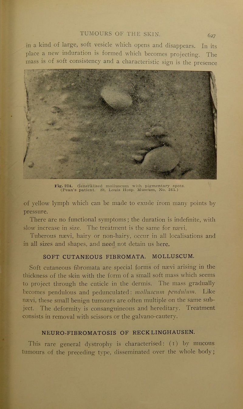in a kincl of large, soft vesicle which opens and disappears. In its place a new induration is formed which becomes projecting. The mass is of soft consistency and a characteristic sign is the presence Fig. 224. Generâlised molluscum tvith pigmentary spots. (Pean’s patient. St. Louis Hosp. Muséum, No. 361.) of yellow lymph which can be made to exude from many points by pressure. There are no functional symptoms ; the duration is indefinite, with slow increase in size. The treatment is the same for nævi. Tuberous nævi, hairy or non-hairy, occur in ail localisations and in ail sizes and shapes, and need not detain us here. SOFT CUTANEOUS FIBROMATA. MOLLUSCUM. Soft cutaneous fibromata are spécial forms of nævi arising in the thickness of the skin with the form of a small soft mass which seems to project through the cuticle in the dermis. The mass gradually becomes pendulous and pedunculated : molluscum pendiilum. Like nævi, these small benign tumours are often multiple on the same sub- ject. The deformitv is consanguineous and hereclitary. Treatment consists in removal with scissors or the galvano-cautery. NEURO-FIBROMATOSIS OF RECK LINGHAUSEN. This rare general dystrophy is characterised: (i) by mucous tumours of the preceding type, disseminated over the whole body ;