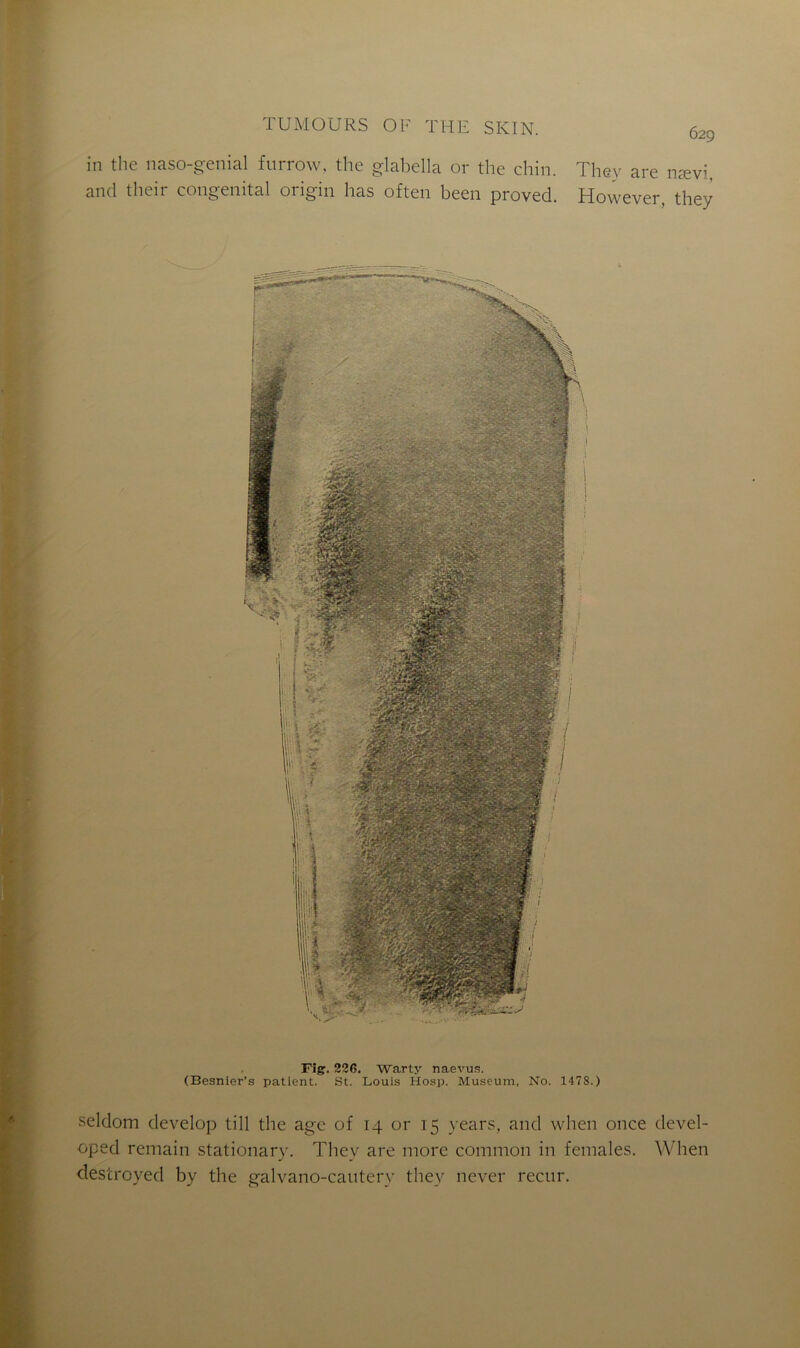 in the naso-genial furrow, the glabella or the chin. and tlieir congénital origin lias often been proved. 629 They are nævi, However, they Fig. 226. Warty naevus. (Besnier’s patient. St. Louis Hosp. Muséum, No. 1478.) seldom develop till the âge of 14 or 15 vears, and when once devel- oped remain stationary. They are more common in females. When destroyed by the galvano-cautery they never recur.
