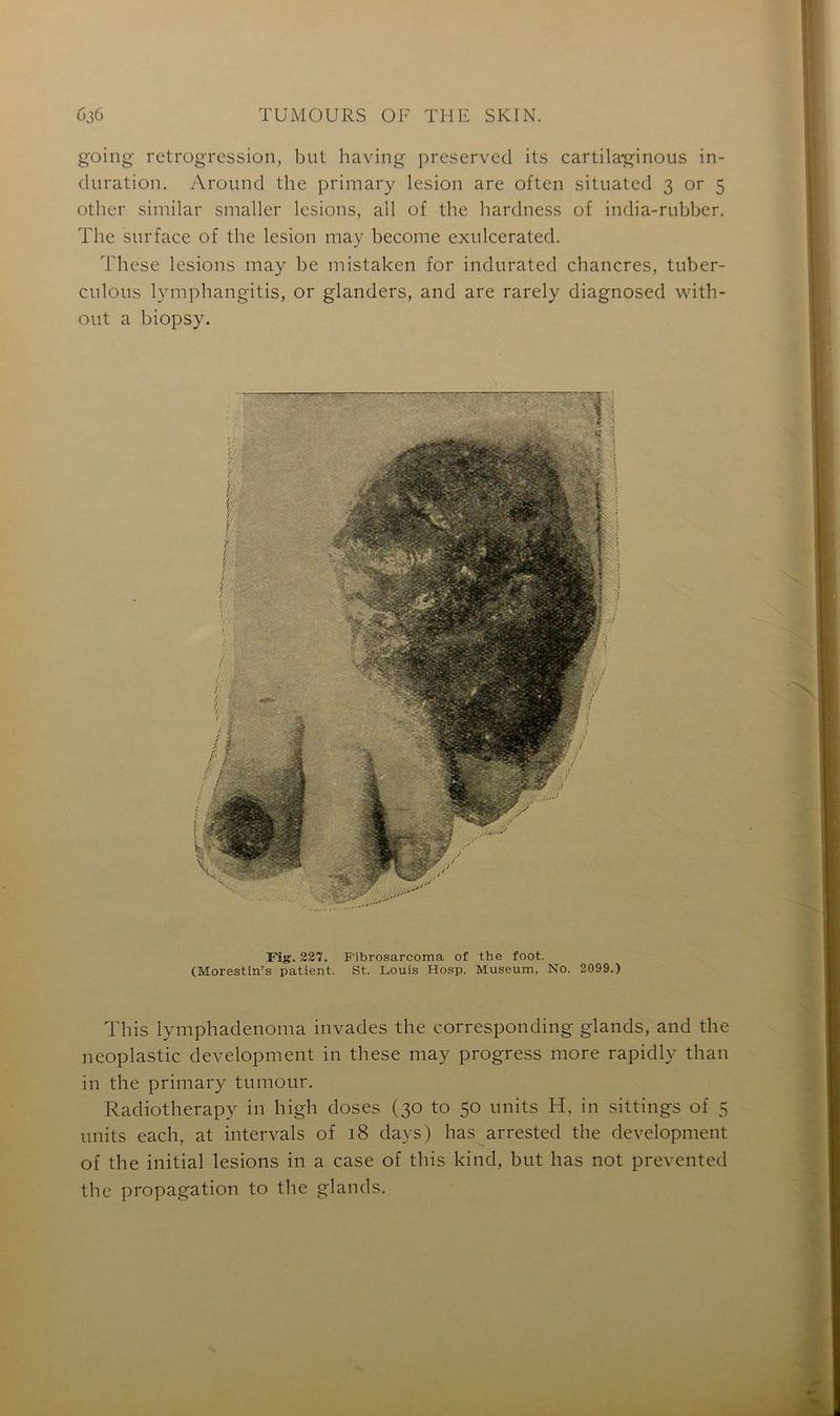 going rétrogression, but having preserved its cartila-ginous in- duration. Around the primary lésion are often situated 3 or 5 other similar smaller lésions, ail of the hardness of india-rubber. The surface of the lésion may become exulcerated. These lésions may be mistaken for indurated chancres, tuber- culôus lymphangitis, or glanders, and are rarely diagnosed with- out a biopsy. Fig. 227. Fibrosarcoma of the foot. (Morestin’s patient. St. Louis Hosp. Muséum, No. 2099.) This lymphadenoma invades the corresponding glands, and the neoplastic development in these may progress more rapidly than in the primary tumour. Radiotherapy in high doses (30 to 50 units H, in sittings of 5 units each, at intervals of 18 days) lias arrested the development of the initial lésions in a case of this kind, but has not prevented the propagation to the glands.