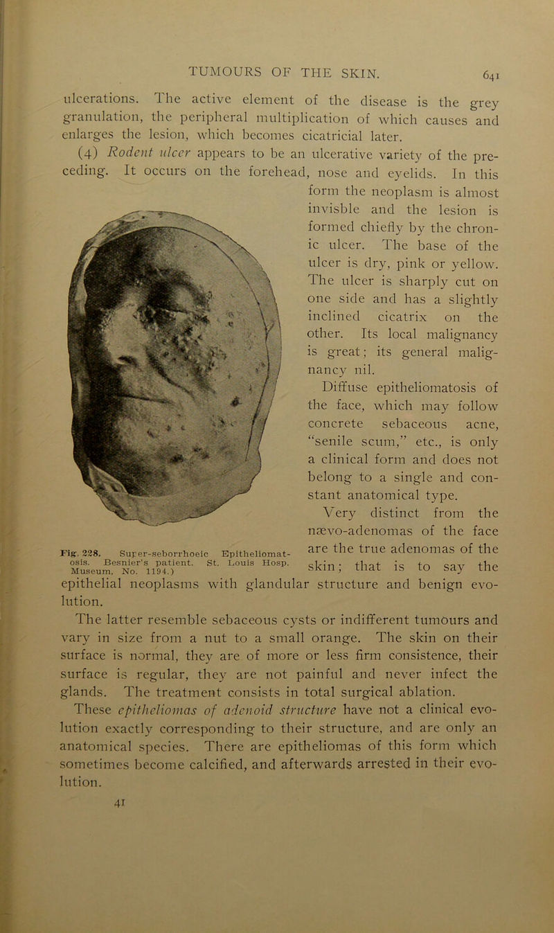 ulcérations. The active element of the disease is the grey granulation, the peripheral multiplication of which causes and enlarges the lésion, which becomes cicatricial later. (4) Rodent ulcer appears to be an ulcerative variety of the pre- ceding. It occurs on the forehead, nose and eyelids. In this form the neoplasm is almost invisble and the lésion is formed chiefly by the chron- ic ulcer. The base of the ulcer is dry, pink or yellow. The ulcer is sharply eut on one side and has a slightly inclined cicatrix on the other. Its local malignancy is great ; its general malig- nancy nil. Diffuse epitheliomatosis of the face, which may follow concrète sebaceous acné, “senile scum,” etc., is only a clinical form and does not belong to a single and con- stant anatomical type. Very distinct from the nævo-adenomas of the face are the true adenomas of the st. louis Hosp. skin • that is to say the épithélial neoplasms with glandular structure and benign évo- lution. The latter resemble sebaceous cysts or indifferent tumours and vary in size from a nut to a small orange. The skin on their surface is normal, they are of more or less firm consistence, their surface is regular, they are not painful and never infect the glands. The treatment consists in total surgical ablation. These epitheliomas of adenoid structure hâve not a clinical évo- lution exactly corresponding to their structure, and are only an anatomical species. There are epitheliomas of this form which sometimes become calcifïed, and afterwards arrested in their évo- lution. Fig, 228, Super-seborrhoeic Epitheliomat osis. Besnier’s patient Muséum, No. 1194.) 41