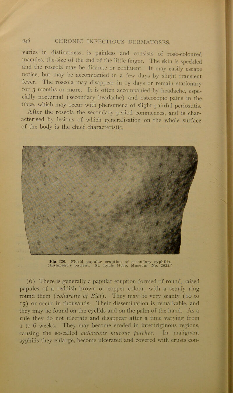 varies in distinctness, is painless and consists of rose-coloured macules, the size of the end of the little finger. The skin is speckled and the roseola may be discrète or confinent. It mav easily escape notice, but may be accompanied in a few days by slight transient lever. The roseola may disappear in 15 days or remain stationary for 3 months or more. Tt is often accompanied by headache, espe- cially nocturnal (secondary headache) and osteocopic pains in the tibiæ, which may occur with phenomena of slight painful periostitis. After the roseola the secondary period commences, and is char- acterised by lésions of which généralisation on the whole surface of the body is the chief characteristic. Fig. 230. Florid papular éruption of secondary syphilis. (Halopeau’s patient. St. Fouis Hosp. Muséum, No. 2022.) (6) There is generally a papular éruption formed of round, raised papules of a reddish brown or copper colour, with a scurfy ring round them (collarette of Bief). They may be very scanty (io to 15) or occur in thousands. Their dissémination is remarkable, and they may be found on the eyelids and on the palm of the hand. As a rule they do not ulcerate and disappear after a time varying from 1 to 6 weeks. They may become eroded in intertriginous régions, causing the so-called cutaneous mucons patelles. In malignant syphilis they enlarge, become ulcerated and covered with crusts con-