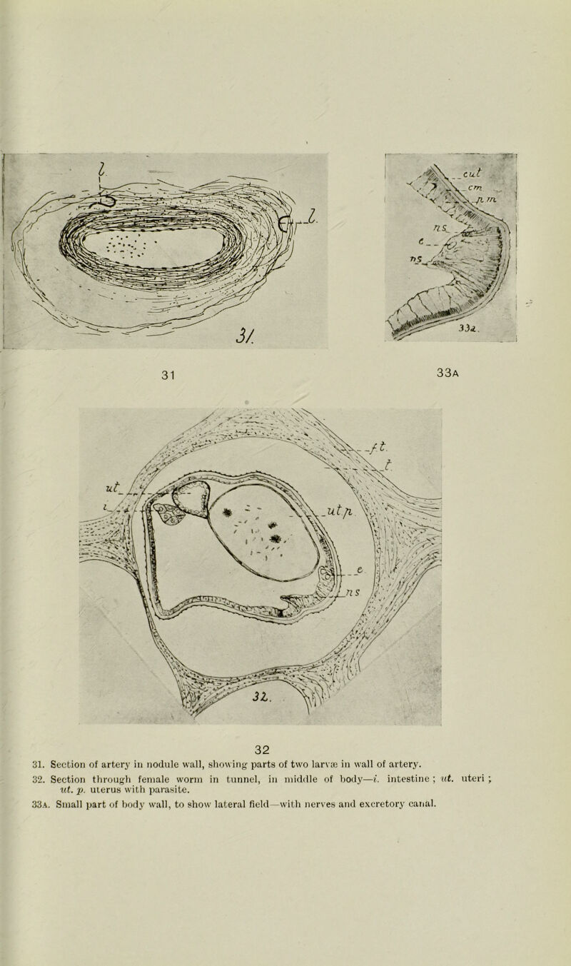 I 31 33a 31. Section of artery in nodule wall, showing parts of two larva) in wall of artery. 32. Section through female worm in tunnel, in middle of body—i. intestine ; at. uteri ; ut. p. uterus with parasite. 33a. Small part of body wall, to show lateral field—with nerves and excretory canal.