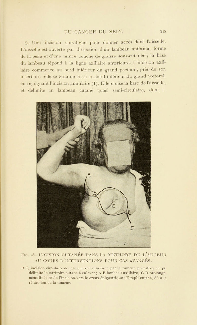 2. Une incision curviligne pour donner accès dans 1 aisselle. L’aisselle est ouverte par dissection d’un lambeau antérieur formé de la peau et d'une mince couche de graisse sous-cutanée ; ]a base du lambeau répond à la ligne axillaire antérieure. L’incision axil- laire commence au bord inférieur du grand pectoral, près de son insertion ; elle se termine aussi au bord inférieur du grand pectoral, en rejoignant l’incision annulaire (1). Elle croise la base de Faisselle, et délimite un lambeau cutané quasi semi-circulaire, dont la Fig. 48. INCISION CUTANEE DANS LA METHODE DE L AUTEUR AU COURS D’INTERVENTIONS POUR CAS AVANCÉS. B C, incision circulaire dont le centre est occupé par la tumeur primitive et qui délimite le territoire cutané à enlever; A B lambeau axillaire; C D prolonge- ment linéaire de l’incision vers le creux épigastrique ; E repli cutané, dû à la rétraction de la tumeur.