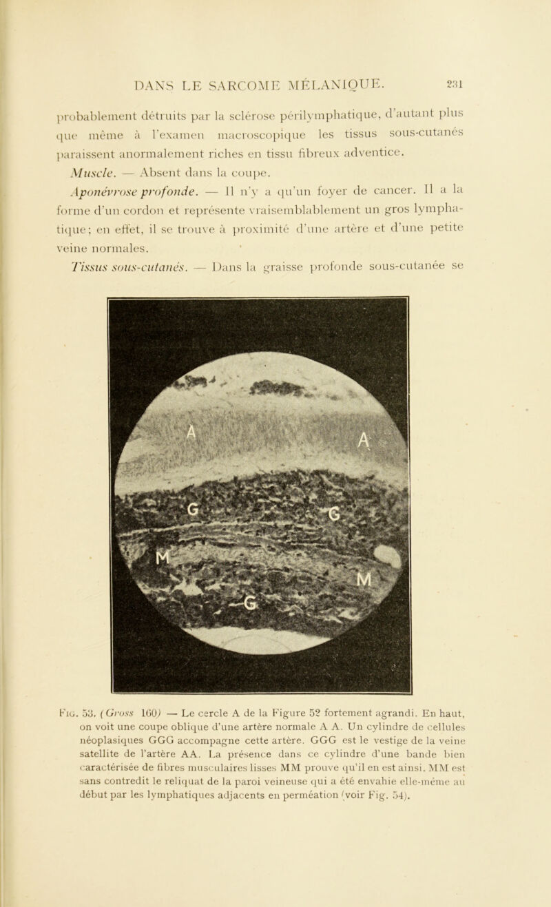 probablement détruits par la sclérose périlymphatique, d autant plus que même à l’examen macroscopique les tissus sous-cutanes ])araissent anormalement riches en tissu fibreux adventice. Muscle. — Absent dans la coupe. Aponévrose profonde. — 11 n’y a qu’un foyer de cancer. Il a la forme d’un cordon et représente vraisemblablement un gros lympha- tique; en effet, il se trouve à proximité d’une artère et d’une petite veine normales. Tissus sous-cutanés. — Dans la graisse profonde sous-cutanée se Fig. 5‘3. ( Gross 1601 — Le cercle A de la Figure 52 fortement agrandi. En haut, on voit une coupe oblique d’une artère normale A A. Un cylindre de cellules néoplasiques GGG accompagne cette artère. GGG est le vestige de la veine satellite de l’artère AA. La présence dans ce cylindre d’une bande bien caractérisée de fibres musculaires lisses MM prouve qu’il en est ainsi. MM est sans contredit le reliquat de la paroi veineuse qui a été envahie elle-même au début par les lymphatiques adjacents en perméation (voir Fig. 54).