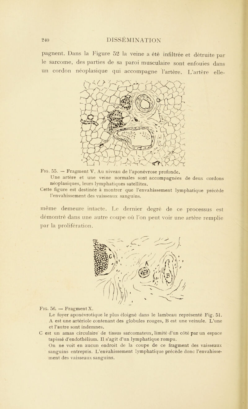 pagnent. Dans la Figure 52 la veine a été infiltrée et détruite par le sarcome, des parties de sa paroi musculaire sont enfouies dans un cordon néoplasique qui accompagne l’artère. L’artère elle- Fig. 55. — Fragment V. Au niveau de l’aponévrose profonde. (Jne artère et une veine normales sont accompagnées de deux cordons néoplasiques, leurs lymphatiques satellites. Cette figure est destinée à montrer que l’envahissement lymphatique précède l’envahissement des vaisseaux sanguins. même demeure intacte. Le dernier degré de ce processus est démontré dans une autre coupe où l’on peut voir une artère remplie par la prolifération. Fig. 5C). — Fragment X. Le foyer aponévrotique le plus éloigné dans le lambeau représenté Fig. 51. A est une artériole contenant des globules rouges, B est une veinule. L’une et l’autre sont indemnes. C est un amas circulaire de tissus sarcomateux, limité d’un côté par un espace tapissé d’endothélium. Il s’agit d’un lymphatique rompu. On ne voit en aucun endroit de la coupe de ce fragment des vaisseaux sanguins entrepris. L’envahissement lymphatique précède donc l’envahisse- ment des vaisseaux sanguins.