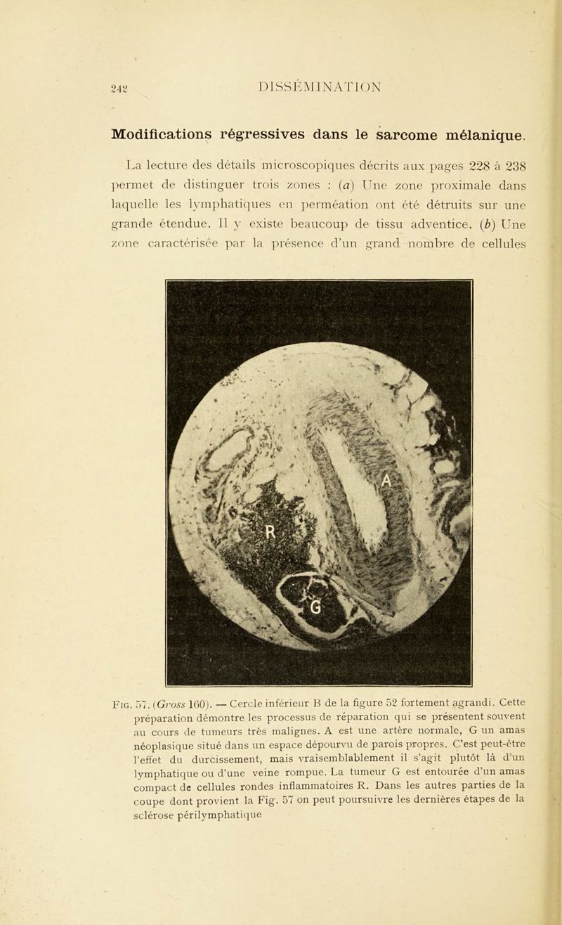 Modifications régressives dans le sarcome mélanicjue. La lecture des détails microscopiques décrits aux pages 228 à 238 permet de distinguer trois zones : (a) Une zone proximale dans laquelle les lymphatiques en perméation ont été détruits sur une grande étendue. Il y existe beaucoup de tissu adventice. (b) Une zone caractérisée par la présence d'un grand nombre de cellules Fig. 57. (Gross 160). — Cercle inférieur B de la figure 52 fortement agrandi. Cette préparation démontre les processus de réparation qui se présentent souvent au cours de tumeurs très malignes. A est une artère normale, G un amas néoplasique situé dans un espace dépourvu de parois propres. C’est peut-être l’effet du durcissement, mais vraisemblablement il s’agit plutôt là d’un lymphatique ou d’une veine rompue. La tumeur G est entourée d’un amas compact de cellules rondes inflammatoires R. Dans les autres parties de la coupe dont provient la Fig. 57 on peut poursuivre les dernières étapes de la sclérose périlymphatique