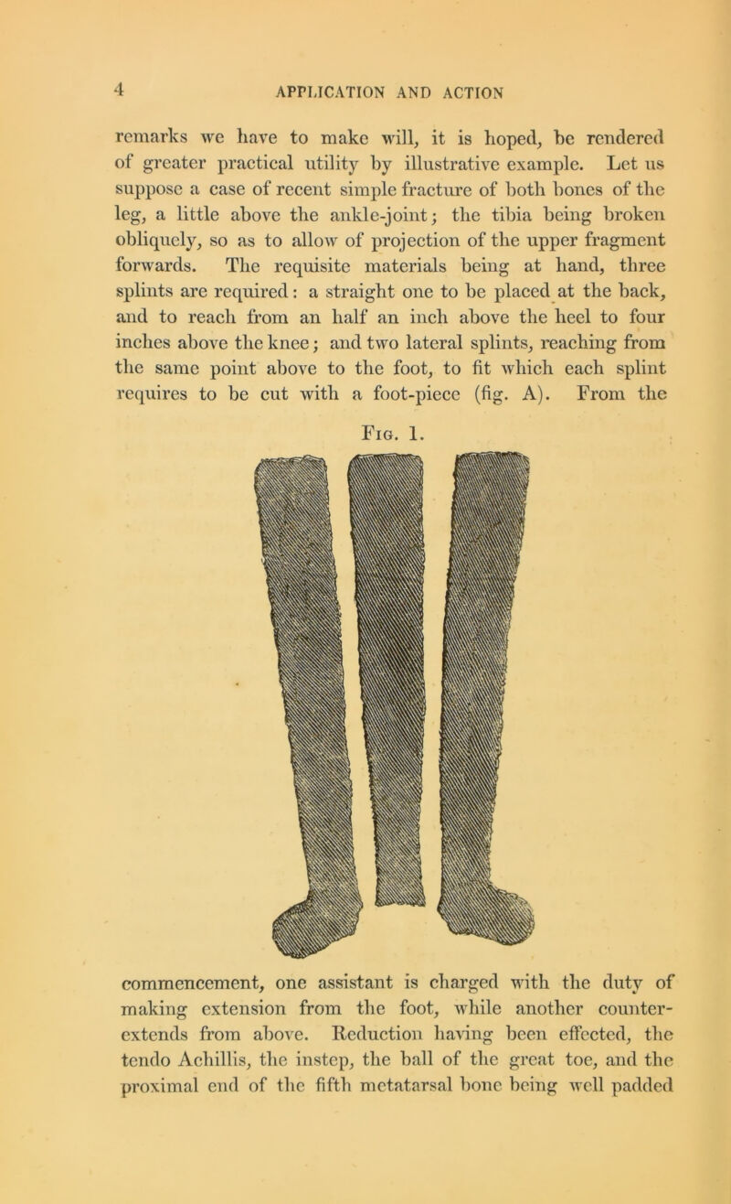 remarks we have to make will, it is hoped, he rendered of greater practical utility by illustrative example. Let us suppose a case of recent simple fracture of both bones of the leg, a little above the ankle-joint; the tibia being broken obliquely, so as to allow of projection of the upper fragment forwards. The requisite materials being at hand, three splints are required: a straight one to be placed at the back, and to reach from an half an inch above the heel to four inches above the knee; and two lateral splints, reaching from the same point above to the foot, to fit which each splint requires to be cut with a foot-piece (fig. A). From the Fig. 1. commencement, one assistant is charged with the duty of making extension from the foot, while another counter- cxtends from above. Reduction having been effected, the tendo Achillis, the instep, the ball of the great toe, and the proximal end of the fifth metatarsal bone being well padded