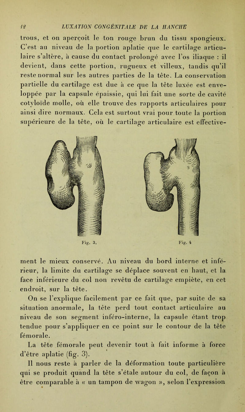 trous, et on aperçoit le ton rouge brun du tissu spongieux. C’est au niveau de la portion aplatie que le cartilage articu- laire s’altère, à cause du contact prolongé avec l’os iliaque : il devient, dans cette portion, rugueux et villeux, tandis qu’il reste normal sur les autres parties de la tête. La conservation partielle du cartilage est due à ce que la tête luxée est enve- loppée par la capsule épaissie, qui lui fait une sorte de cavité cotyloïde molle, où elle trouve des rapports articulaires pour ainsi dire normaux. Cela est surtout vrai pour toute la portion supérieure de la tête, où le cartilage articulaire est elfective- Fig. 3. Fig. 4 ment le mieux conservé. Au niveau du bord interne et infé- rieur, la limite du cartilage se déplace souvent en haut, et la face inférieure du col non revêtu de cartilage empiète, en cet endroit, sur la tête. On se l’explique facilement par ce fait que, par suite de sa situation anormale, la tête perd tout contact articulaire au niveau de son segment inféro-interne, la capsule étant trop tendue pour s’appliquer en ce point sur le contour de la tête fémorale. La tête fémorale peut devenir tout à fait informe h force d’être aplatie (fig. 3). Il nous reste à parler de la déformation toute particulière qui se produit quand la tête s’étale autour du col, de façon à être comparable à « un tampon de wagon », selon l’expression