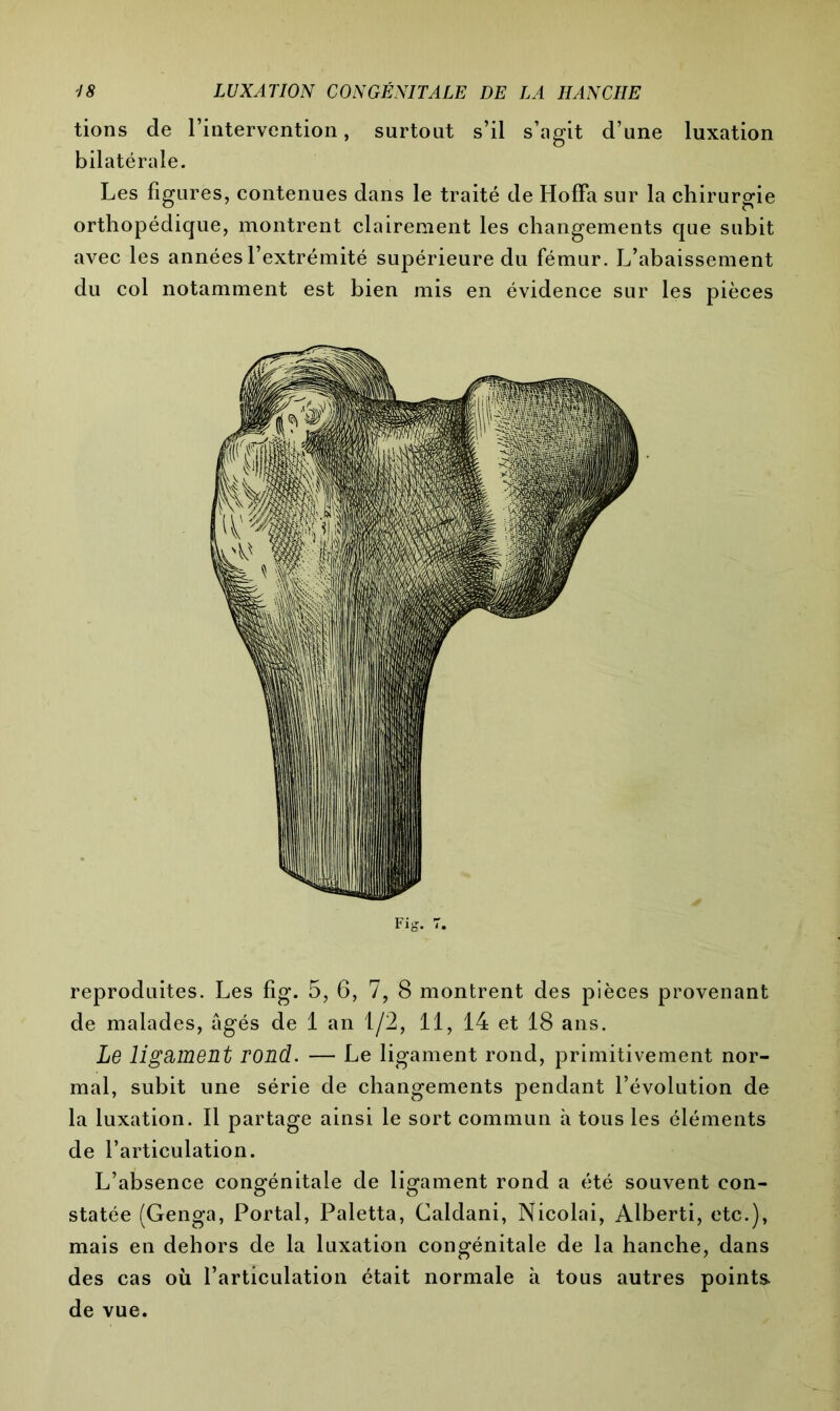 tions de l’intervention, surtout s’il s’agit d’une luxation bilatérale. Les figures, contenues dans le traité de HofFa sur la chirurgie orthopédique, montrent clairement les changements que subit avec les années l’extrémité supérieure du fémur. L’abaissement du col notamment est bien mis en évidence sur les pièces reproduites. Les fig. 5, 6, 7, 8 montrent des pièces provenant de malades, âgés de 1 an 1/2, 11, 14 et 18 ans. Le ligament rond. — Le ligament rond, primitivement nor- mal, subit une série de changements pendant l’évolution de la luxation. Il partage ainsi le sort commun à tous les éléments de l’articulation. L’absence congénitale de ligament rond a été souvent con- statée (Genga, Portal, Paletta, Caldani, Nicolai, Alberti, etc.), mais en dehors de la luxation congénitale de la hanche, dans des cas où l’articulation était normale à tous autres points de vue.