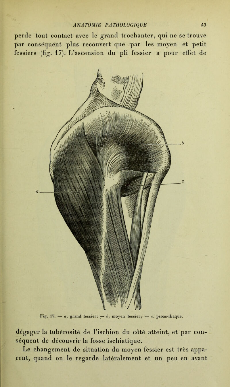 perde tout contact avec le grand trochanter, qui ne se trouve par conséquent plus recouvert que par les moyen et petit fessiers (fig. 17). L’ascension du pli fessier a pour effet de dégager la tubérosité de l’ischion du côté atteint, et par con- séquent de découvrir la fosse ischiatique. Le changement de situation du moyen fessier est très appa- rent, quand on le regarde latéralement et un peu en avant