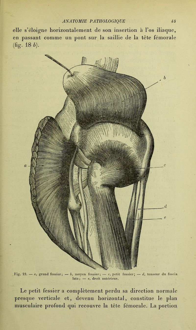 elle s’éloigne horizontalement de son insertion à l’os iliaque, en passant comme un pont sur la saillie de la tête fémorale (fig. 18 b). Fig. 19. — a, grand fessier; — b, moyen fessier; — c, petit fessier; — d, tenseur du fascia lata ; — e, droit antérieur. Le petit fessier a complètement perdu sa direction normale presque verticale et, devenu horizontal, constitue le plan musculaire profond qui recouvre la tête fémorale. La portion