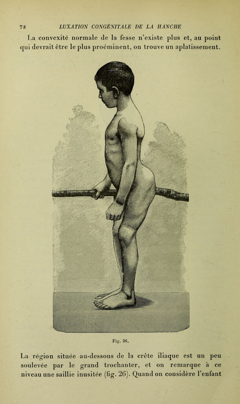 La convexité normale de la fesse n’existe plus et, au point qui devrait être le plus proéminent, on trouve un aplatissement. Fig. 26. La région située au-dessous de la crête iliaque est un peu soulevée par le grand trochanter, et on remarque à ce niveau une saillie inusitée (fig. 26). Quand on considère l’enfant