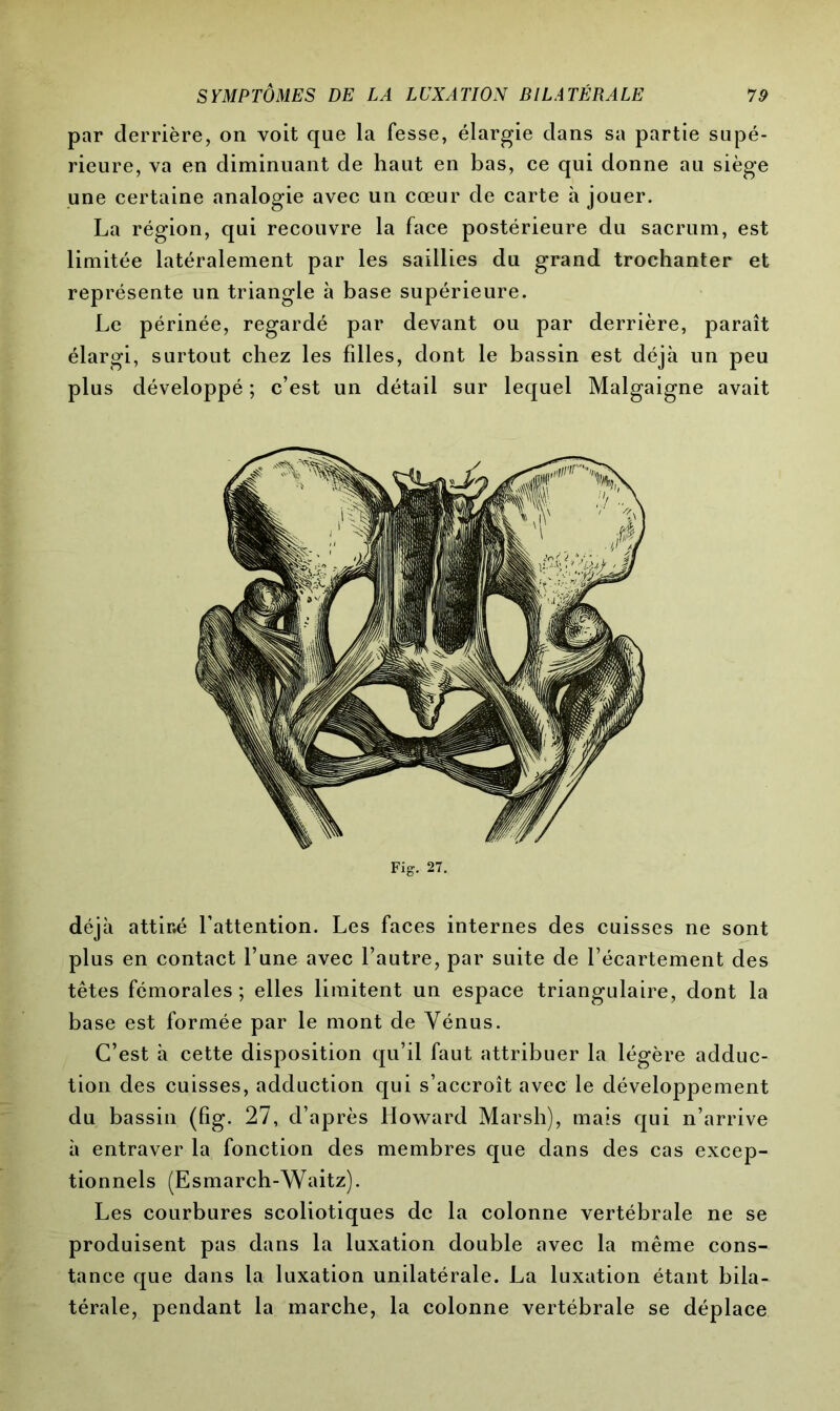 par derrière, on voit que la fesse, élargie dans sa partie supé- rieure, va en diminuant de haut en bas, ce qui donne au siège une certaine analogie avec un cœur de carte à jouer. La région, qui recouvre la face postérieure du sacrum, est limitée latéralement par les saillies du grand trochanter et représente un triangle à base supérieure. Le périnée, regardé par devant ou par derrière, paraît élargi, surtout chez les fdles, dont le bassin est déjà un peu plus développé ; c’est un détail sur lequel Malgaigne avait Fig. 27. déjà attiré l’attention. Les faces internes des cuisses ne sont plus en contact l’une avec l’autre, par suite de l’écartement des têtes fémorales ; elles limitent un espace triangulaire, dont la base est formée par le mont de Vénus. C’est à cette disposition qu’il faut attribuer la légère adduc- tion des cuisses, adduction qui s’accroît avec le développement du bassin (fig. 27, d’après Howard Marsh), mais qui n’arrive à entraver la fonction des membres que dans des cas excep- tionnels (Esmarch-Waitz). Les courbures scoliotiques de la colonne vertébrale ne se produisent pas dans la luxation double avec la même cons- tance que dans ta luxation unilatérale. La luxation étant bila- térale, pendant la marche, la colonne vertébrale se déplace