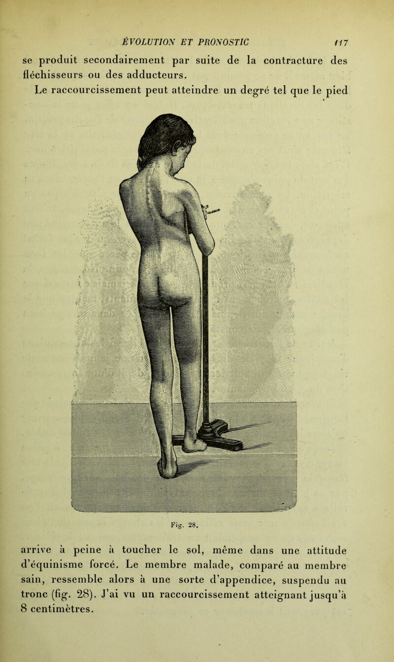 se produit secondairement par suite de la contracture des fléchisseurs ou des adducteurs. Le raccourcissement peut atteindre un degré tel que le pied arrive à peine à toucher le sol, même dans une attitude d’équinisme forcé. Le membre malade, comparé au membre sain, ressemble alors à une sorte d’appendice, suspendu au tronc (fig. 28). J’ai vu un raccourcissement atteignant jusqu’à 8 centimètres.