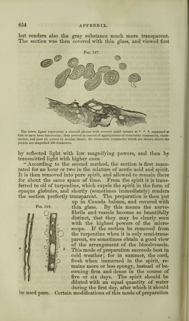 but renders also the gray substance mucli more transparent. The section was then covered with thin glass, and viewed first Fig. 347. The lower figure represents a choroid plexus with several small tumors at * * *, supposed at first to have been tubercular; they proved to consist of aggregations of concentric corpuscles, chole- sterine, and pure oil, united by areolar tissue; the concentric corpuscles which are shown above the plexus are magnified 100 diameters. by reflected light with low magnifying powers, and then by transmitted light with higher ones. “According to the second method, the section is first mace- rated for an hour or two in the mixture of acetic acid and spirit. It is then removed into pure spirit, and allowed to remain there for about the same space of time. From the spirit it is trans- ferred to oil of turpentine, which expels the spirit in the form of opaque globules, and shortly (sometimes immediately) renders the section perfectly transparent. The preparation is then put up in Canada balsam, and covered with thin glass. By this means the nerve- fibrils and vessels become so beautifully distinct, that they may be clearly seen with the highest powers of the micro- scope. If the section be removed from the turpentine when it is only semi-trans- parent, we sometimes obtain a good view of the arrangement of the bloodvessels. This mode of preparation succeeds best in cold weather; for in summer, the cord, fresh when immersed in the spirit, re- mains more or less spongy, instead of be- coming firm and dense in the course of five or six days. The spirit should be diluted with an equal quantity of water during the first day, after which it should be used pure. Certain modifications of this mode of preparation X