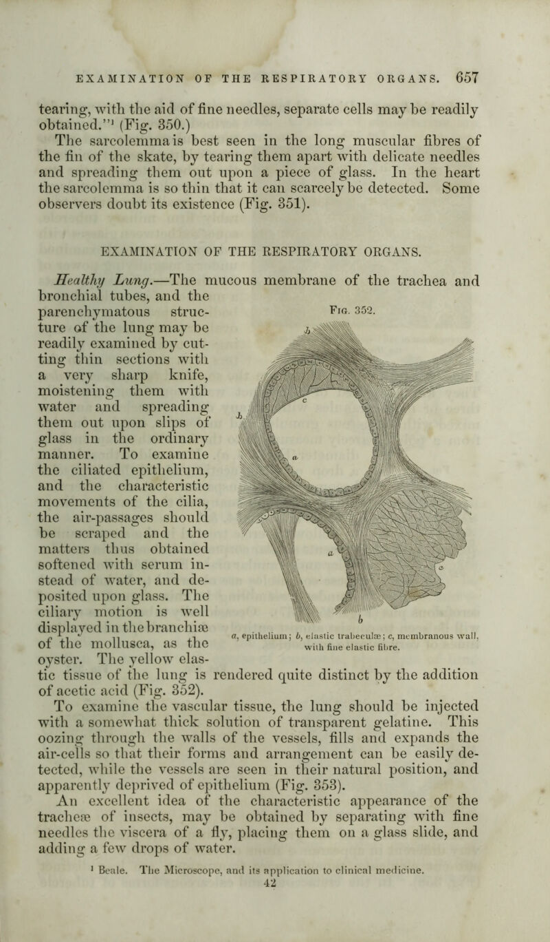 tearing, with the aid of fine needles, separate cells maybe readily obtained.”1 (Fig. 350.) The sarcolemmais best seen in the long muscular fibres of the fin of the skate, by tearing them apart with delicate needles and spreading them out upon a piece of glass. In the heart the sarcolemma is so thin that it can scarcely be detected. Some observers doubt its existence (Fig. 351). EXAMINATION OF THE RESPIRATORY ORGANS. Healthy Lung.—The mucous membrane of the trachea and bronchial tubes, and the parenchymatous struc- Fig- 352. ture of the lung may be readily examined by cut- ting thin sections with a very sharp knife, moistening them with water and spreading them out upon slips of glass in the ordinary manner. To examine the ciliated epithelium, and the characteristic movements of the cilia, the air-passages should be scraped and the matters thus obtained softened with serum in- stead of water, and de- posited upon glass. The ciliary motion is well displayed in the branchiae of the mollusca, as the oyster. The yellow elas- tic tissue of the lung is rendered quite distinct by the addition of acetic acid (Fig. 352). To examine the vascular tissue, the lung should be injected with a somewhat thick solution of transparent gelatine. This oozing through the walls of the vessels, fills and expands the air-cells so that their forms and arrangement can be easily de- tected, while the vessels are seen in their natural position, and apparently deprived of epithelium (Fig. 353). An excellent idea of the characteristic appearance of the tracheae of insects, may be obtained by separating with fine needles the viscera of a fly, placing them on a glass slide, and adding a few drops of water. a, epithelium; b, elastic trabeculae; c, membranous wall, with fine elastic fibre. 1 Beale. The Microscope, and its application to clinical medicine. 42