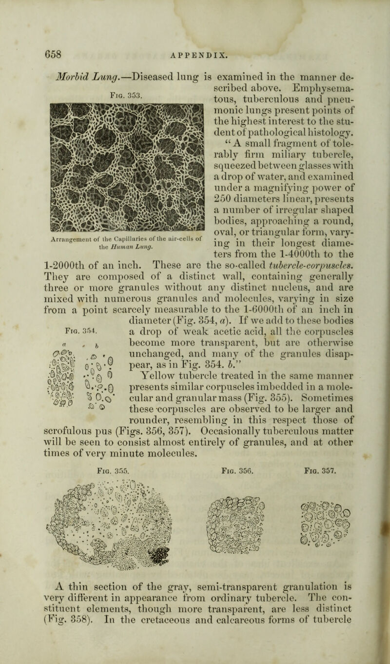 Morbid Lung.—Diseased lung is examined in the manner de- scribed above. Emphysema- tous, tuberculous and pneu- monic lungs present points of the highest interest to the stu- dent of pathological histology. “A small fragment of tole- rably firm miliary tubercle, squeezed between glasses with a drop of water, and examined under a magnifying power of 250 diameters linear, presents a number of irregular shaped bodies, approaching a round, oval, or triangular form, vary- ing in their longest diame- ters from the l-4000th to the l-2000th of an inch. These are the so-called tubercle-corpuscles. They are composed of a distinct wall, containing generally three or more granules without any distinct nucleus, and are mixed with numerous granules and molecules, varying in size from a point scarcely measurable to the l-6000th of an inch in diameter (Fig. 354, a). If we add to these bodies a drop of weak acetic acid, all the corpuscles become more transparent, but are otherwise unchanged, and many of the granules disap- Arrangement of the Capillaries of the air-cells of the Human Lung. Fia. 354. O-®. ’0. <*-®$ @:©& 'd'g 0 s & % O.q’ ■S pear, as in Fig. 354. 5.” © Yellow tubercle treated in the same manner presents similar corpuscles imbedded in a mole- cular and granular mass (Fig. 355). Sometimes these -corpuscles are observed to he larger and rounder, resembling in this respect those of scrofulous pus (Figs. 356, 35T). Occasionally tuberculous matter will be seen to consist almost entirely of granules, and at other times of very minute molecules. Fia. 355. Fig. 356. Fig. 357. A thin section of the gray, semi-transparent granulation is very different in appearance from ordinary tubercle. The con- stituent elements, though more transparent, are less distinct (Fig. 358). In the cretaceous and calcareous forms of tubercle