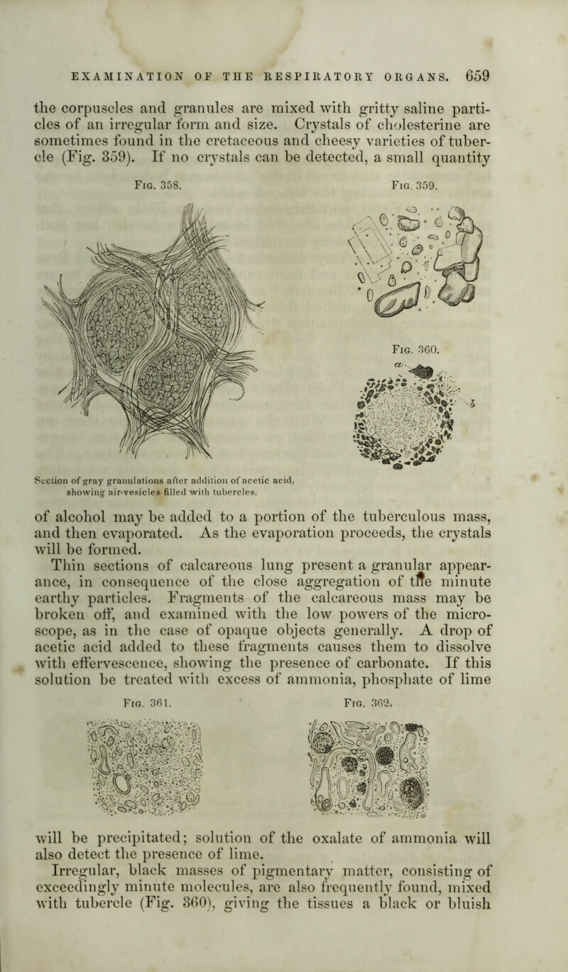 the corpuscles and granules are mixed with gritty saline parti- cles of an irregular form and size. Crystals of cholesterine are sometimes found in the cretaceous and cheesy varieties of tuber- cle (Fig. 359). If no crystals can be detected, a small quantity Fig. 358. Fig. 359. Section of gray granulations after addition of acetic acid, showing air-vesicles filled with tubercles. of alcohol may he added to a portion of the tuberculous mass, and then evaporated. As the evaporation proceeds, the crystals will be formed. Thin sections of calcareous lung present a granular appear- ance, in consequence of the close aggregation of tfle minute earthy particles. Fragments of the calcareous mass may be broken off, and examined with the low powers of the micro- scope, as in the case of opaque objects generally. A drop of acetic acid added to these fragments causes them to dissolve with effervescence, showing the presence of carbonate. If this solution be treated with excess of ammonia, phosphate of lime Fig. 361. Fig. 362, will be precipitated; solution of the oxalate of ammonia will also detect the presence of lime. Irregular, black masses of pigmentary matter, consisting of exceedingly minute molecules, are also frequently found, mixed with tubercle (Fig. 360), giving the tissues a black or bluish