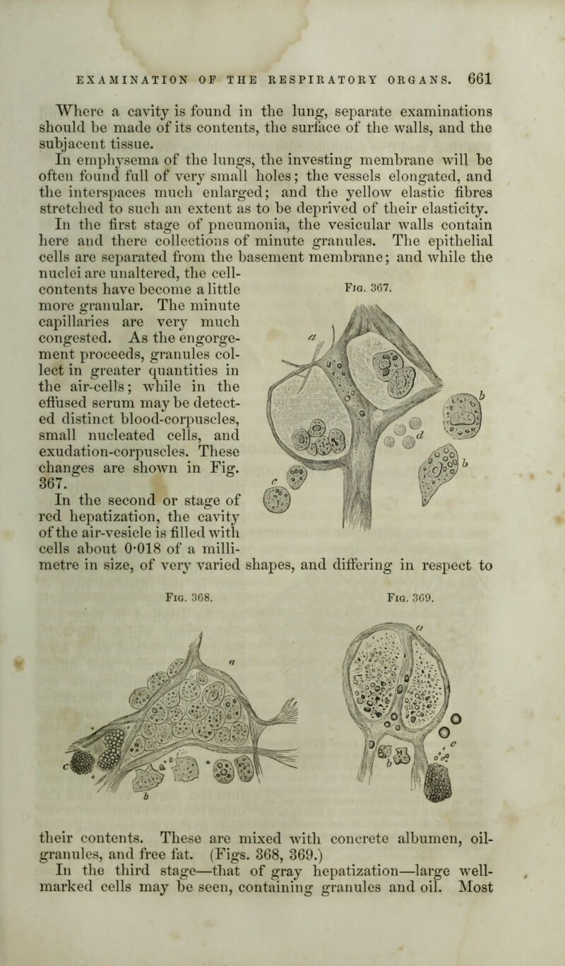 Where a cavity is found in the lung, separate examinations should be made of its contents, the surface of the walls, and the subjacent tissue. In emphysema of the lungs, the investing membrane will be often found full of very small holes; the vessels elongated, and the interspaces much enlarged; and the yellow elastic fibres stretched to such an extent as to be deprived of their elasticity. In the first stage of pneumonia, the vesicular walls contain here and there collections of minute granules. The epithelial cells are separated from the basement membrane; and while the nuclei are unaltered, the cell- contents have become a little Fig. 367. more granular. The minute capillaries are very much congested. As the engorge- ment proceeds, granules col- lect in greater quantities in the air-cells; while in the effused serum may be detect- ed distinct blood-corpuscles, small nucleated cells, ancl exudation-corpuscles. These changes are shown in Fig. 367. In the second or stage of red hepatization, the cavity of the air-vesicle is filled with cells about 0*018 of a milli- metre in size, of very varied shapes, and differing in respect to Fig. 368. Fig. 369. their contents. These are mixed with concrete albumen, oil- granules, and free fat. (Figs. 368, 369.) In the third stage—that of gray hepatization—large well- marked cells may be seen, containing granules and oil. Most