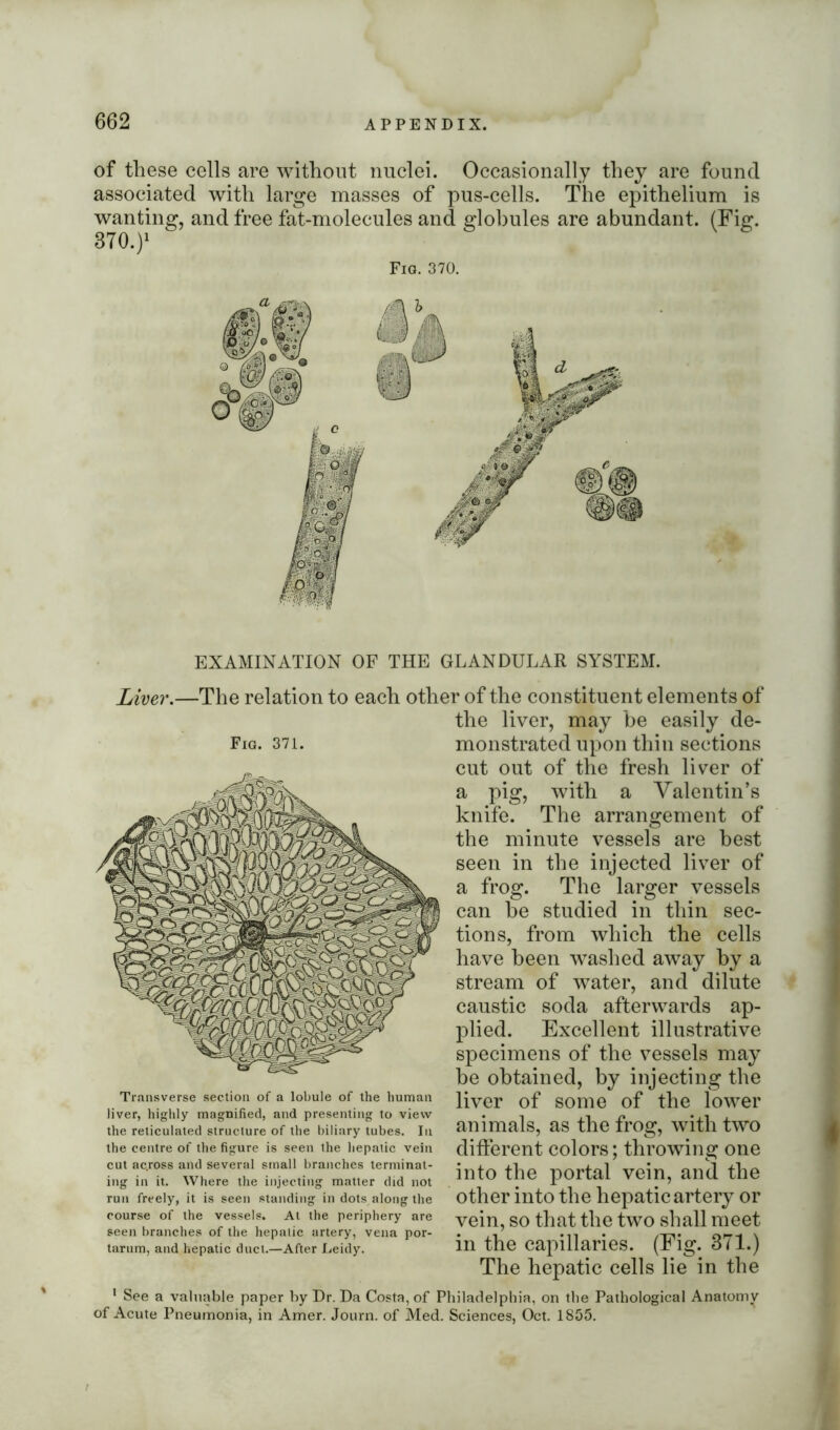 of these cells are without nuclei. Occasionally they are found associated with large masses of pus-cells. The epithelium is wanting, and free fat-molecules and globules are abundant. (Fig. 370.)1 Fia. 370. EXAMINATION OF THE GLANDULAR SYSTEM. Liver.—The relation to each other of the constituent elements of Fig. 371. Transverse section of a lobule of the human liver, highly magnified, and presenting to view the reticulated structure of the biliary tubes. In the centre of the figure is seen the hepatic vein cut ac.ross and several small branches terminat- ing in it. Where the injecting matter did not run freely, it is seen standing in dots along the course of the vessels. At the periphery are seen branches of the hepatic artery, vena por- tarum, and hepatic duct.—After Leidy. 1 See a valuable paper by Dr. Da Costa, of F of Acute Pneumonia, in Amer. Journ. of Med. the liver, may be easily de- monstrated upon thin sections cut out of the fresh liver of a pig, with a Valentin’s knife. The arrangement of the minute vessels are best seen in the injected liver of a frog. The larger vessels can be studied in thin sec- tions, from which the cells have been washed away by a stream of water, and dilute caustic soda afterwards ap- plied. Excellent illustrative specimens of the vessels may be obtained, by injecting the liver of some of the lower animals, as the frog, with two different colors; throwing one into the portal vein, and the other into the hepatic artery or vein, so that the two shall meet in the capillaries. (Fig. 371.) The hepatic cells lie in the hiladelphia, on the Pathological Anatomy Sciences, Oct. 1855. /