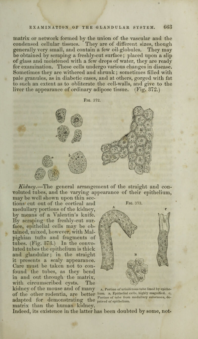 matrix or network formed by the union of the vascular and the condensed cellular tissues. They are of different sizes, though generally very small, and contain a few oil-globules. They may be obtained by scraping a freshly-cut surface; placed upon a slip of glass and moistened with a few drops of water, they are ready for examination. These cells undergo various changes in disease. Sometimes they are withered and shrunk; sometimes filled with pale granules, as in diabetic cases, and at others, gorged with fat to such an extent as to obliterate the cell-walls, and give to the liver the appearance of ordinary adipose tissue. (Fig. 372.) Fig. 372. Fig. 373. V(Vij Kidney.—The general arrangement of the straight and con- voluted tubes, ancl the varying appearance of their epithelium, may be well shown upon thin sec- tions cut out of the cortical and medullary portions of the kidney, by means of a Valentin’s knife. By scraping the freshly-cut sur- face, epithelial cells may be ob- tained, mixed, however, with Mal- pighian tufts and fragments of tubes. (Fig. 373.) In the convo- luted tubes the epithelium is thick and glandular; in the straight it presents a scaly appearance. Care must be taken not to con- found the tubes, as they bend in and out through the matrix, with circumscribed cysts. The kidney of the mouse and of many of the other rodentia, are better adapted for demonstrating the matrix than the human kidney. Indeed, its existence in the latter has been doubted by some, not- a, Portion of uriniferous tube lined by epithe- lium. b, Epithelial cells, highly magnified, c. Portion of tube from medullary substance, de- prived of epithelium.