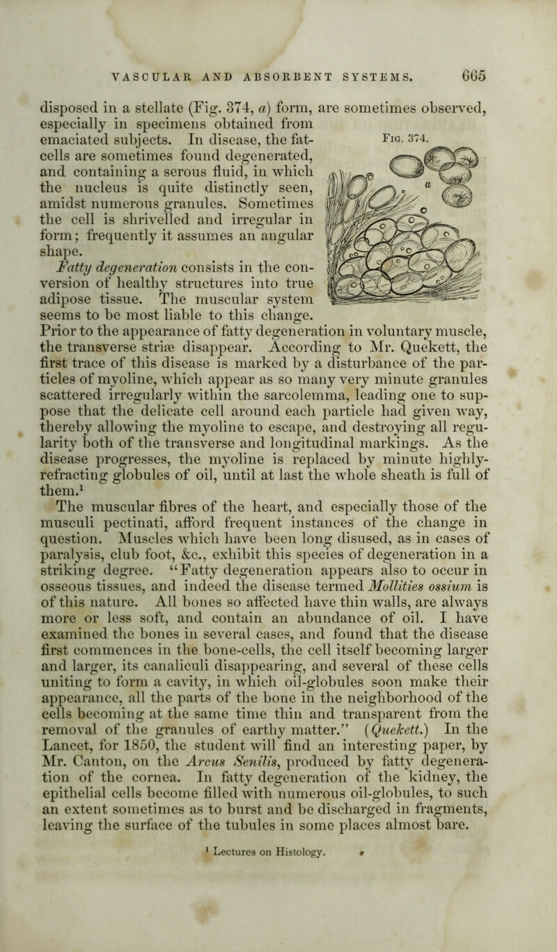 Fig. 374. disposed in a stellate (Fig. 374, a) form, are sometimes observed, especially in specimens obtained from emaciated subjects. In disease, the fat- cells are sometimes found degenerated, and containing a serous fluid, in which the nucleus is quite distinctly seen. amidst numerous granules, cell Sometimes the cell is shrivelled and irregular in form; frequently it assumes an angular shape. Fatty degeneration consists in the con- version of healthy structures into true adipose tissue. The muscular system seems to be most liable to this change. Prior to the appearance of fatty degeneration in voluntary muscle, the transverse striae disappear. According to Mr. Quekett, the first trace of this disease is marked by a disturbance of the par- ticles of myoline, which appear as so many very minute granules scattered irregularly within the sarcolemma, leading one to sup- pose that the delicate cell around each particle had given way, thereby allowing the myoline to escape, and destroying all regu- larity both of the transverse and longitudinal markings. As the disease progresses, the myoline is replaced by minute highly- refracting globules of oil, until at last the whole sheath is full of them.1 The muscular fibres of the heart, and especially those of the musculi pectinati, afford frequent instances of the change in question. Muscles which have been long disused, as in cases of paralysis, club foot, &c., exhibit this species of degeneration in a striking degree. “Fatty degeneration appears also to occur in osseous tissues, and indeed the disease termed Mollities ossium is of this nature. All bones so affected have thin walls, are always more or less soft, and contain an abundance of oil. I have examined the bones in several cases, and found that the disease first commences in the bone-cells, the cell itself becoming larger and larger, its canaliculi disappearing, and several of these cells uniting to form a cavity, in which oil-globules soon make their appearance, all the parts of the bone in the neighborhood of the cells becoming at the same time thin and transparent from the removal of the granules of earthy matter.” [Quekett.) In the Lancet, for 1850, the student will find an interesting paper, by Mr. Canton, on the Arcus Senilis, produced by fatty degenera- tion of the cornea. In fatty degeneration of the kidney, the epithelial cells become filled with numerous oil-globules, to such an extent sometimes as to burst and be discharged in fragments, leaving the surface of the tubules in some places almost bare. Lectures on Histology.
