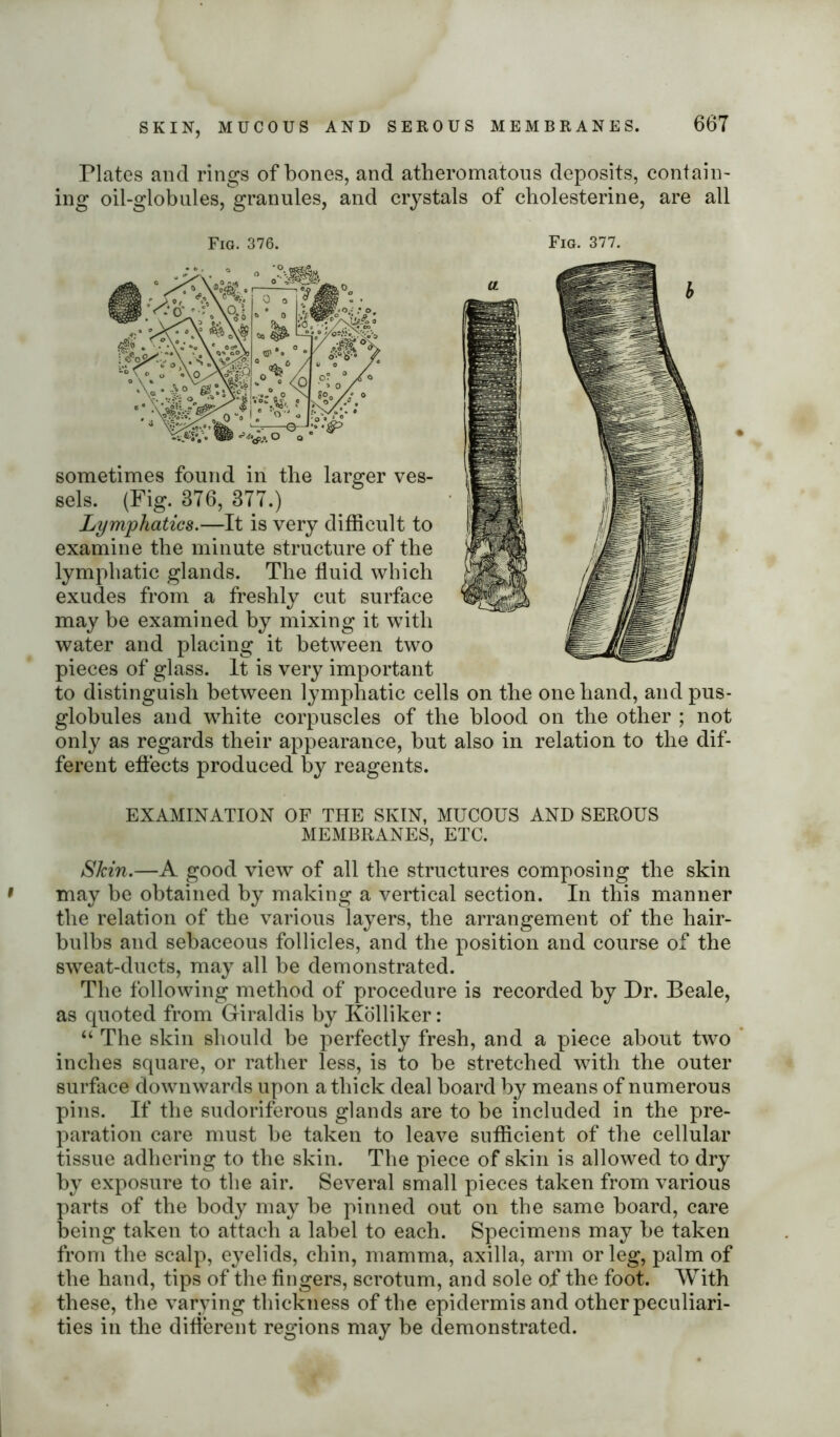 Plates and rings of bones, and atheromatous deposits, contain- ing oil-globules, granules, and crystals of cholesterine, are all Fig. 376. Fig. 377. O a sometimes found in the larger ves- sels. (Fig. 376, 377.) Lymphatics.—It is very difficult to examine the minute structure of the lymphatic glands. The fluid which exudes from a freshly cut surface may be examined by mixing it with water and placing it between two pieces of glass. It is very important to distinguish between lymphatic cells on the one hand, and pus- globules and white corpuscles of the blood on the other ; not only as regards their appearance, but also in relation to the dif- ferent effects produced by reagents. EXAMINATION OF THE SKIN, MUCOUS AND SEROUS MEMBRANES, ETC. Skin.—A good view of all the structures composing the skin may be obtained by making a vertical section. In this manner the relation of the various layers, the arrangement of the hair- bulbs and sebaceous follicles, and the position and course of the sweat-ducts, may all be demonstrated. The following method of procedure is recorded by Dr. Beale, as quoted from Giraldis by Kolliker: “ The skin should be perfectly fresh, and a piece about two inches square, or rather less, is to be stretched with the outer surface downwards upon a thick deal board by means of numerous pins. If the sudoriferous glands are to be included in the pre- paration care must be taken to leave sufficient of the cellular tissue adhering to the skin. The piece of skin is allowed to dry by exposure to the air. Several small pieces taken from various parts of the body may be pinned out on the same board, care being taken to attach a label to each. Specimens may be taken from the scalp, eyelids, chin, mamma, axilla, arm or leg, palm of the hand, tips of the fingers, scrotum, and sole of the foot. With these, the varying thickness of the epidermis and other peculiari- ties in the different regions may be demonstrated.