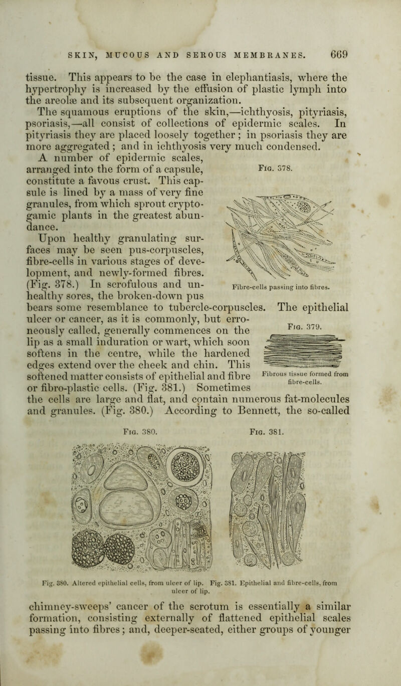 tissue. This appears to be the case in elephantiasis, where the hypertrophy is increased by the effusion of plastic lymph into the areolae and its subsequent organization. The squamous eruptions of the skin,—ichthyosis, pityriasis, psoriasis,—all consist of collections of epidermic scales. In pityriasis they are placed loosely together ; in psoriasis they are more aggregated ; and in ichthyosis very much condensed. A number of epidermic scales, arranged into the form of a capsule, constitute a favous crust. This cap- sule is lined by a mass of very fine granules, from which sprout crypto - gamic plants in the greatest abun- dance. Upon healthy granulating sur- faces may be seen pus-corpuscles, fibre-cells in various stages of deve- lopment, and newly-formed fibres. (Fig. 378.) In scrofulous and un- healthy sores, the broken-down pus bears some resemblance to tubercle-corpuscles. The epithelial ulcer or cancer, as it is commonly, but erro- neously called, generally commences on the lip as a small induration or wart, which soon softens in the centre, while the hardened edges extend over the cheek and chin. This softened matter consists of epithelial and fibre Fibrous tissue formed from 1 nhrp.pp k or fibro-plastic cells. (Fig. 381.) Sometimes the cells are large and flat, and contain numerous fat-molecules and granules. (Fig. 380.) According to Bennett, the so-called Fig. 379. Fig. 378. V; '  ' * \ '•* -C-.. _= ' ' V s ■ Li > ■ ^ V\C\ Fibre-cells passing into fibres. Fig. 380. Fig. 381. Fig. 380. Altered epithelial cells, from ulcer of lip. Fig. 381. Epithelial and fibre-cells, from ulcer of lip. chimney-sweeps’ cancer of the scrotum is essentially a similar formation, consisting externally of flattened epithelial scales passing into fibres; and, deeper-seated, either groups of younger
