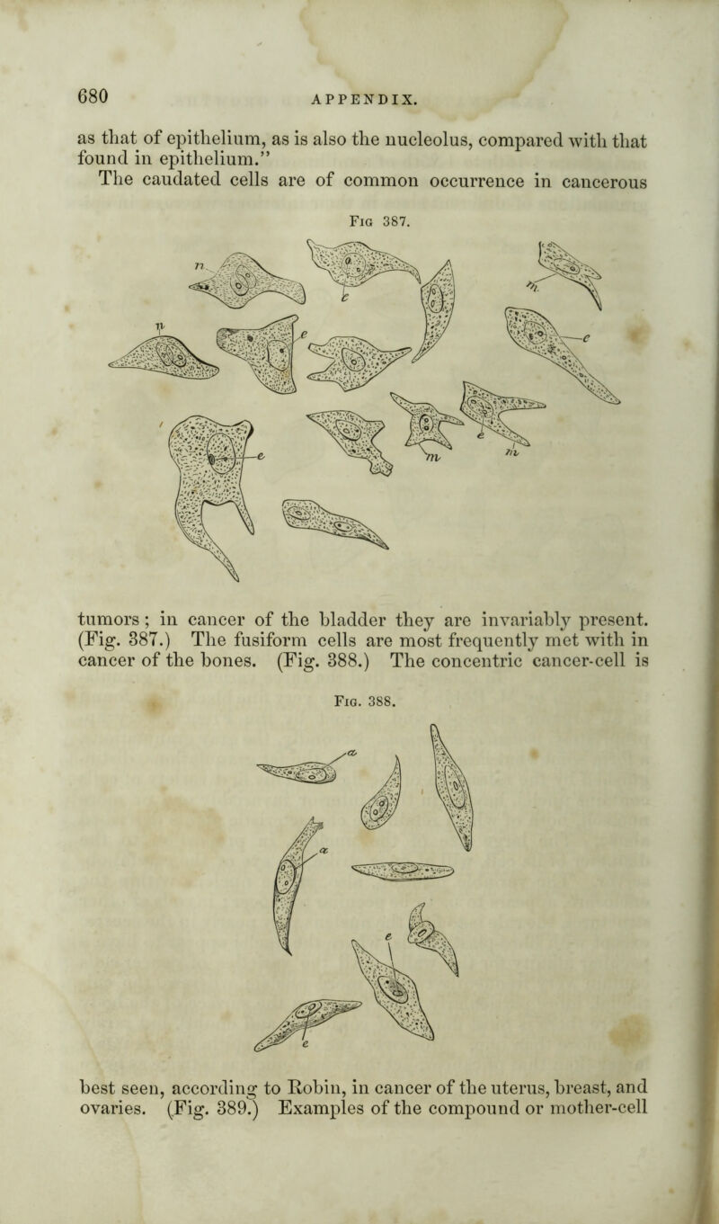 as that of epithelium, as is also the nucleolus, compared with that found in epithelium.” The caudated cells are of common occurrence in cancerous Fig 387. tumors; in cancer of the bladder they are invariably present. (Fig. 887.) The fusiform cells are most frequently met with in cancer of the bones. (Fig. 888.) The concentric cancer-cell is Fig. 388. best seen, according to Robin, in cancer of the uterus, breast, and ovaries. (Fig. 889.) Examples of the compound or mother-cell