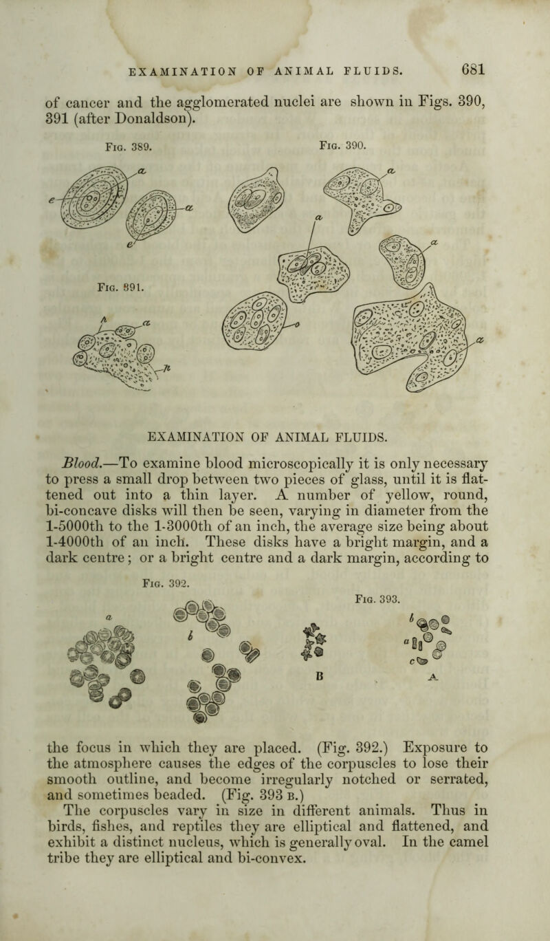 of cancer and the agglomerated nuclei are shown in Figs. 890, 391 (after Donaldson). Fig. 389. Fig. 390. EXAMINATION OF ANIMAL FLUIDS. Blood.—To examine blood microscopically it is only necessary to press a small drop between two pieces of glass, until it is flat- tened out into a thin layer. A number of yellow, round, bi-concave disks will then be seen, varying in diameter from the l-5000th to the 1-3000th of an inch, the average size being about l-4000tb of an inch. These disks have a bright margin, and a dark centre; or a bright centre and a dark margin, according to Fig. 392. Fig. 393. A. the focus in which they are placed. (Fig. 392.) Exposure to the atmosphere causes the edges of the corpuscles to lose their smooth outline, and become irregularly notched or serrated, and sometimes beaded. (Fig. 393 b.) The corpuscles vary in size in different animals. Thus in birds, fishes, and reptiles they are elliptical and flattened, and exhibit a distinct nucleus, which is generally oval. In the camel tribe they are elliptical and bi-convex.