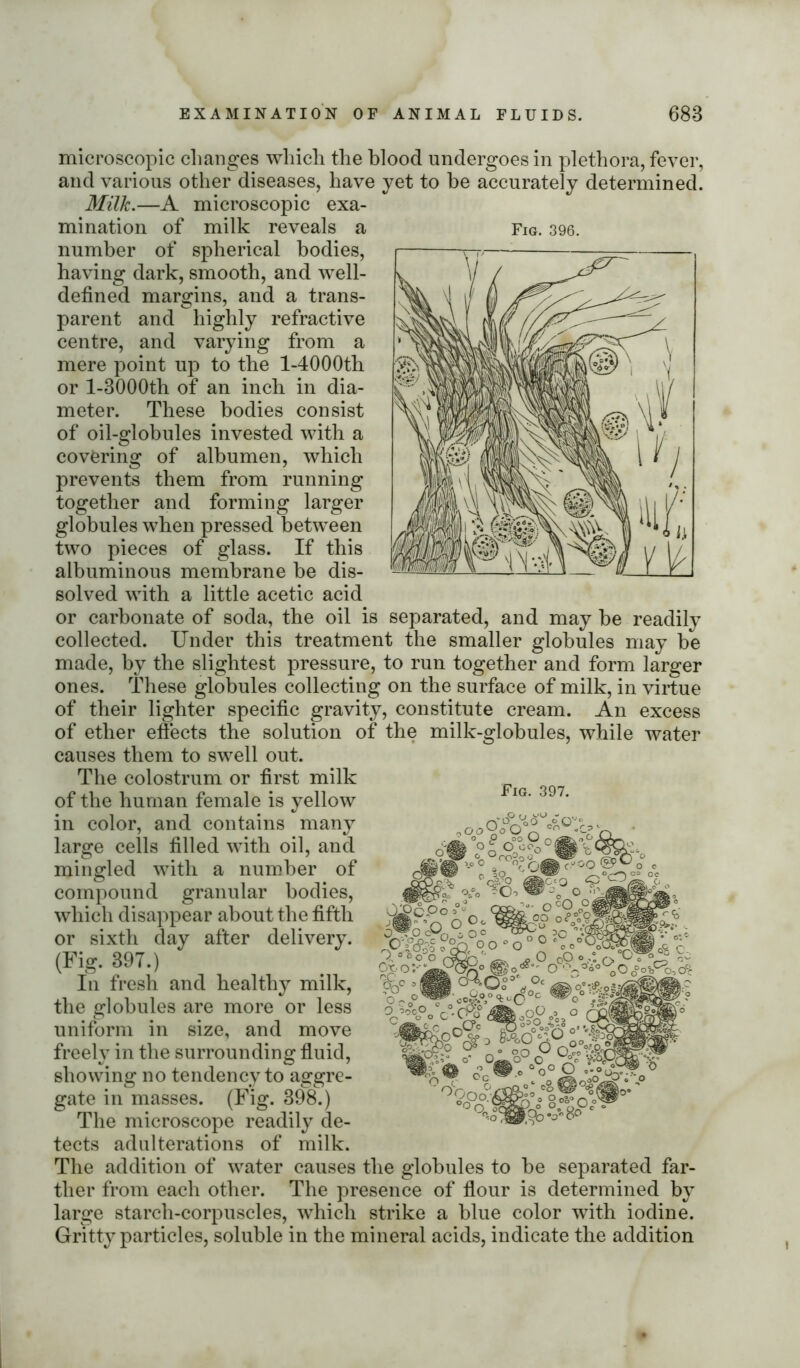 separated, and may be readily microscopic changes which the blood undergoes in plethora, fever, and various other diseases, have yet to be accurately determined. Milk.—A microscopic exa- mination of milk reveals a Fig. 396. number of spherical bodies, having dark, smooth, and well- defined margins, and a trans- parent and highly refractive centre, and varying from a mere point up to the l-4000th or l-3000th of an inch in dia- meter. These bodies consist of oil-globules invested with a covering of albumen, which prevents them from running together and forming larger globules when pressed between two pieces of glass. If this albuminous membrane be dis- solved with a little acetic acid or carbonate of soda, the oil is collected. Under this treatment the smaller globules may be made, by the slightest pressure, to run together and form larger ones. These globules collecting on the surface of milk, in virtue of their lighter specific gravity, constitute cream. An excess of ether effects the solution of the milk-globules, while water causes them to swell out. The colostrum or first milk of the human female is yellow in color, and contains many large cells filled with oil, and mingled with a number of compound granular bodies, which disappear about the fifth or sixth day after delivery. (Fig. 397.) In fresh and healthy milk, the globules are more or less uniform in size, and move freely in the surrounding fluid, showing no tendency to aggre- gate in masses. (Fig. 398.) The microscope readily de- tects adulterations of milk. The addition of water causes the globules to tlier from each other. The presence of flour large starch-corpuscles, which strike a blue color with iodine. Gritty particles, soluble in the mineral acids, indicate the addition Fig. 397. Or. o o~, OPcP° 5%;o O O 0O •' O .o °0° O S5P*- be separated far- determined bv is