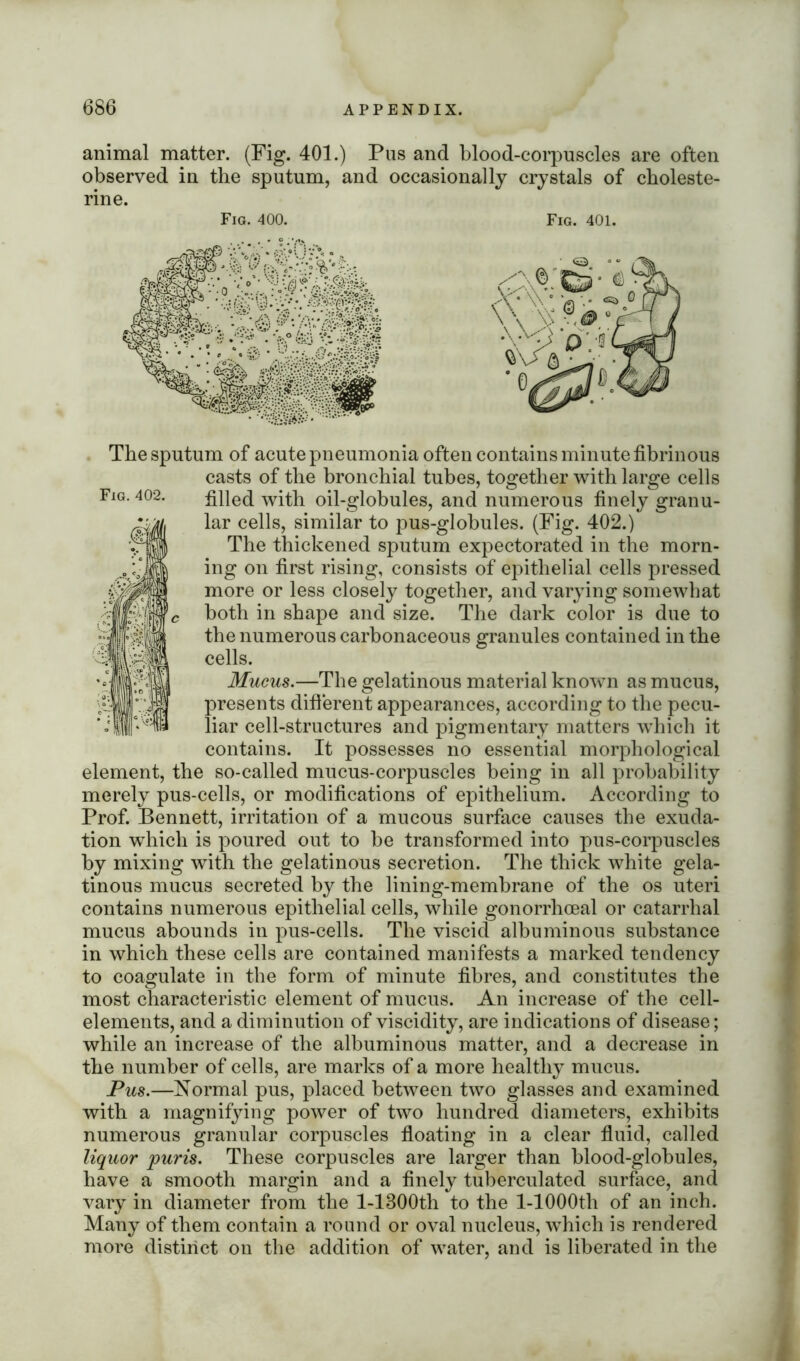 animal matter. (Fig. 401.) Pus and blood-corpuscles are often observed in the sputum, and occasionally crystals of choleste- rine. Fig. 400. Fig. 401. The sputum of acute pneumonia often contains minute fibrinous casts of the bronchial tubes, together with large cells filled with oil-globules, and numerous finely granu- lar cells, similar to pus-globules. (Fig. 402.) The thickened sputum expectorated in the morn- ing on first rising, consists of epithelial cells pressed more or less closely together, and varying somewhat both in shape and size. The dark color is due to the numerous carbonaceous granules contained in the cells. Mucus.—The gelatinous material known as mucus, presents different appearances, according to the pecu- liar cell-structures and pigmentary matters which it contains. It possesses no essential morphological element, the so-called mucus-corpuscles being in all probability merely pus-cells, or modifications of epithelium. According to Prof. Bennett, irritation of a mucous surface causes the exuda- tion which is poured out to be transformed into pus-corpuscles by mixing with the gelatinous secretion. The thick white gela- tinous mucus secreted by the lining-membrane of the os uteri contains numerous epithelial cells, while gonorrhoeal or catarrhal mucus abounds in pus-cells. The viscid albuminous substance in which these cells are contained manifests a marked tendency to coagulate in the form of minute fibres, and constitutes the most characteristic element of mucus. An increase of the cell- elements, and a diminution of viscidity, are indications of disease; while an increase of the albuminous matter, and a decrease in the number of cells, are marks of a more healthy mucus. Pus.—Normal pus, placed between two glasses and examined with a magnifying power of two hundred diameters, exhibits numerous granular corpuscles floating in a clear fluid, called liquor puris. These corpuscles are larger than blood-globules, have a smooth margin and a finely tuberculated surface, and vary in diameter from the l-1300th to the l-1000th of an inch. Many of them contain a round or oval nucleus, which is rendered more distinct on the addition of water, and is liberated in the Fig. 402.