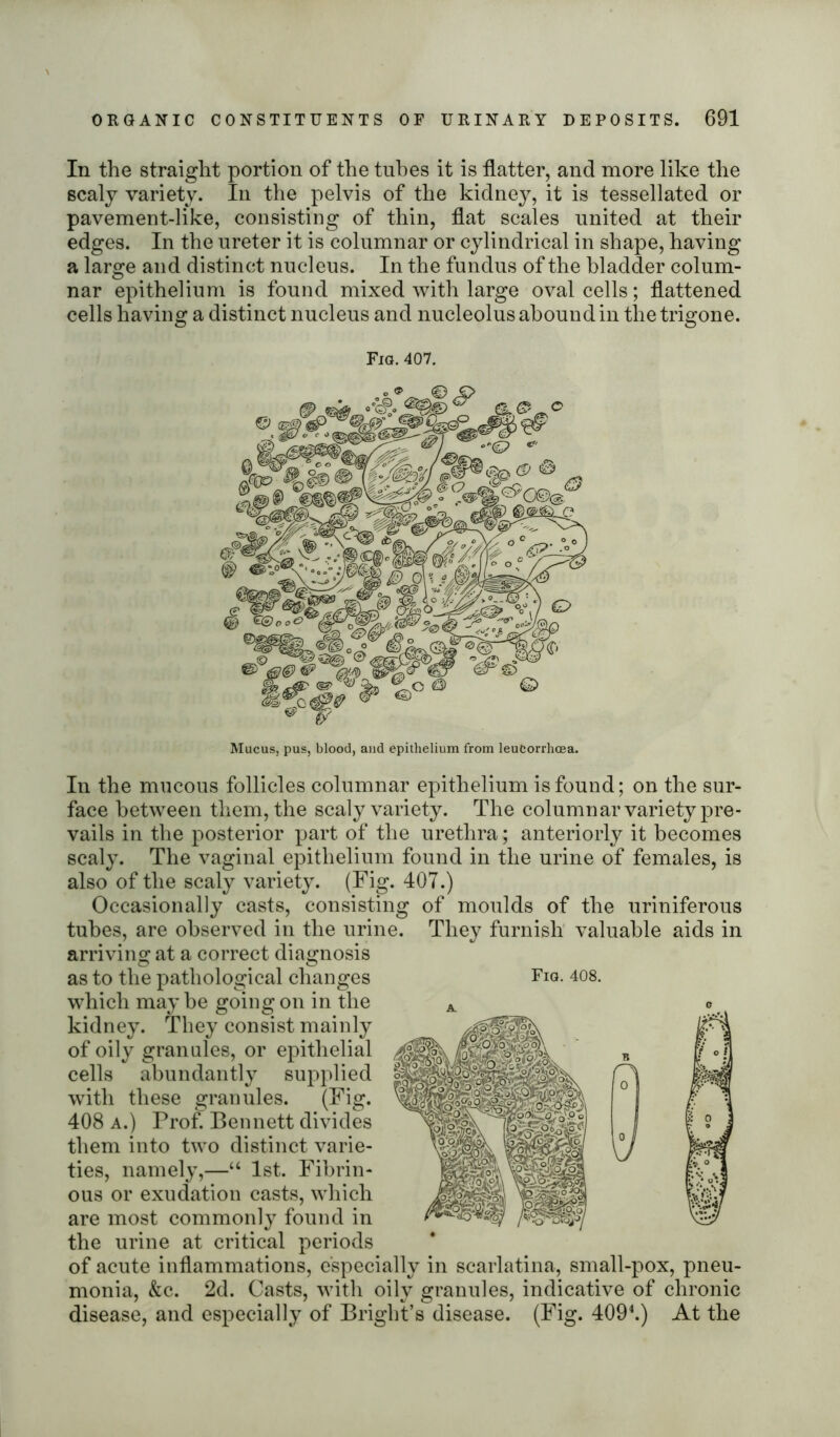 In the straight portion of the tubes it is flatter, and more like the scaly variety. In the pelvis of the kidney, it is tessellated or pavement-like, consisting of thin, flat scales united at their edges. In the ureter it is columnar or cylindrical in shape, having a large and distinct nucleus. In the fundus of the bladder colum- nar epithelium is found mixed with large oval cells; flattened cells having a distinct nucleus and nucleolus abound in the trigone. Fig. 407. Mucus, pus, blood, and epithelium from leutorrhoea. In the mucous follicles columnar epithelium is found; on the sur- face between them, the scaly variety. The columnar variety pre- vails in the posterior part of the urethra; anteriorly it becomes scaly. The vaginal epithelium found in the urine of females, is also of the scaly variety. (Fig. 407.) Occasionally casts, consisting of moulds of the uriniferous tubes, are observed in the urine. They furnish valuable aids in arriving at a correct diagnosis as to the pathological changes which maybe goingon in the kidney. They consist mainly of oily grannies, or epithelial cells abundantly supplied with these granules. (Fig. 408 a.) Prof. Bennett divides them into two distinct varie- ties, namely,—“ 1st. Fibrin- ous or exudation casts, which are most commonly found in the urine at critical periods of acute inflammations, especially in scarlatina, small-pox, pneu- monia, &c. 2d. Casts, with oily granules, indicative of chronic disease, and especially of Bright’s disease. (Fig. 4094.) At the