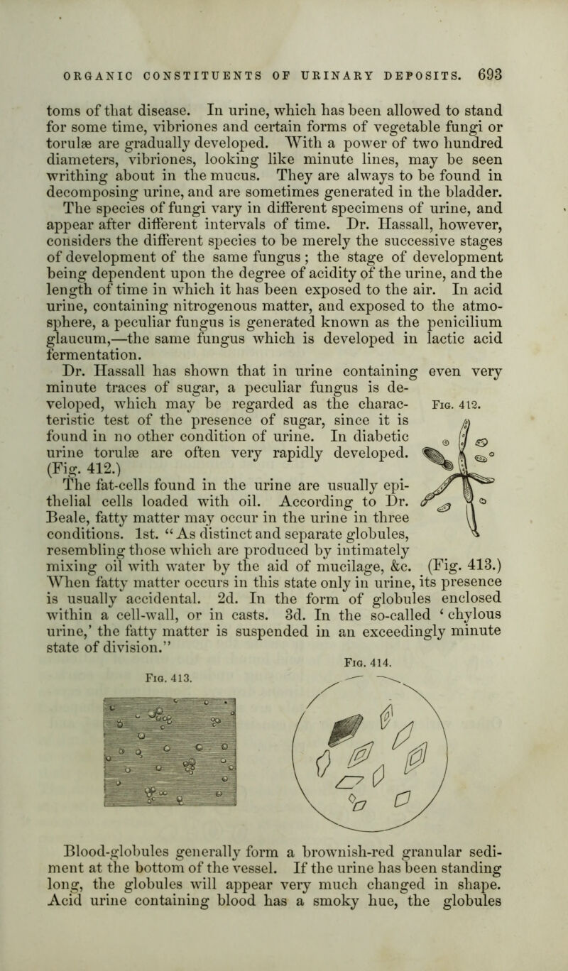 toms of that disease. In urine, which has been allowed to stand for some time, vibriones and certain forms of vegetable fungi or torulse are gradually developed. With a power of two hundred diameters, vibriones, looking like minute lines, may he seen writhing about in the mucus. They are always to he found in decomposing urine, and are sometimes generated in the bladder. The species of fungi vary in different specimens of urine, and appear after different intervals of time. Dr. Hassall, however, considers the different species to he merely the successive stages of development of the same fungus ; the stage of development being dependent upon the degree of acidity of the urine, and the length of time in which it has been exposed to the air. In acid urine, containing nitrogenous matter, and exposed to the atmo- sphere, a peculiar fungus is generated known as the penicilium glaucum,—the same fungus which is developed in lactic acid fermentation. Dr. Hassall has shown that in urine containing even very minute traces of sugar, a peculiar fungus is de- veloped, which may be regarded as the charac- Fig. 412. teristic test of the presence of sugar, since it is found in no other condition of urine. In diabetic urine torulse are often very rapidly developed. (Fig. 412.) The fat-cells found in the urine are usually epi- thelial cells loaded with oil. According to Dr. Beale, fatty matter may occur in the urine in three conditions. 1st. “ As distinct and separate globules, resembling those which are produced by intimately mixing oil with water by the aid of mucilage, &c. (Fig. 413.) Wlien fatty matter occurs in this state only in urine, its presence is usually accidental. 2d. In the form of globules enclosed within a cell-wall, or in casts. 3d. In the so-called 6 chylous urine,’ the fatty matter is suspended in an exceedingly minute state of division.” Fig. 414. Fig. 413. Blood-globules generally form a hrownish-red granular sedi- ment at the bottom of the vessel. If the urine has been standing long, the globules will appear very much changed in shape. Acid urine containing blood has a smoky hue, the globules