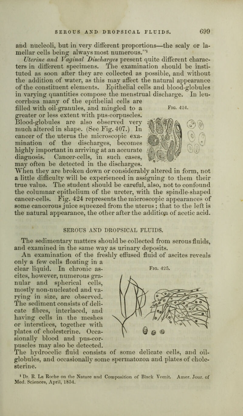 Fig. 424. U\ and nucleoli, but in very different proportions—the scaly or la- mellar cells being always most numerous.”1 Uterine and Vaginal Discharges present quite different charac- ters in different specimens. The examination should be insti- tuted as soon after they are collected as possible, and without the addition of water, as this may affect the natural appearance of the constituent elements. Epithelial cells and blood-globules in varying quantities compose the menstrual discharge. In leu- corrhcea many of the epithelial cells are filled with oil-granules, and mingled to a greater or less extent with pus-corpuscles. Blood-globules are also observed very much altered in shape. (See Fig. 407.) In cancer of the uterus the microscopic exa- mination of the discharges, becomes highly important in arriving at an accurate diagnosis. Cancer-cells, in such cases, may often be detected in the discharges. When they are broken down or considerably altered in form, not a little difficulty will be experienced in assigning to them their true value. The student should be careful, also, not to confound the columnar epithelium of the ureter, with the spindle-shaped cancer-cells. Fig. 424 represents the microscopic appearances of some cancerous juice squeezed from the uterus ; that to the left is the natural appearance, the other after the addition of acetic acid. SEROUS AND DROPSICAL FLUIDS. The sedimentary matters should be collected from serous fluids, and examined in the same way as urinary deposits. An examination of the freshly effused fluid of ascites reveals only a few cells floating in a clear liquid. In chronic as- cites, however, numerous gra- nular and spherical cells, mostly non-nucleated and va- rying in size, are observed. The sediment consists of deli- cate fibres, interlaced, and having cells in the meshes or interstices, together with plates of cholesterine. Occa- sionally blood and pus-cor- puscles may also be detected. The hydrocelic fluid consists of some delicate cells, and oil- globules, and occasionally some spermatozoa and plates of chole- sterine. 1 Dr. R. La Roche on the Nature and Composition of Black Vomit. Arner. Jour, of Med. Sciences, April, 1854.
