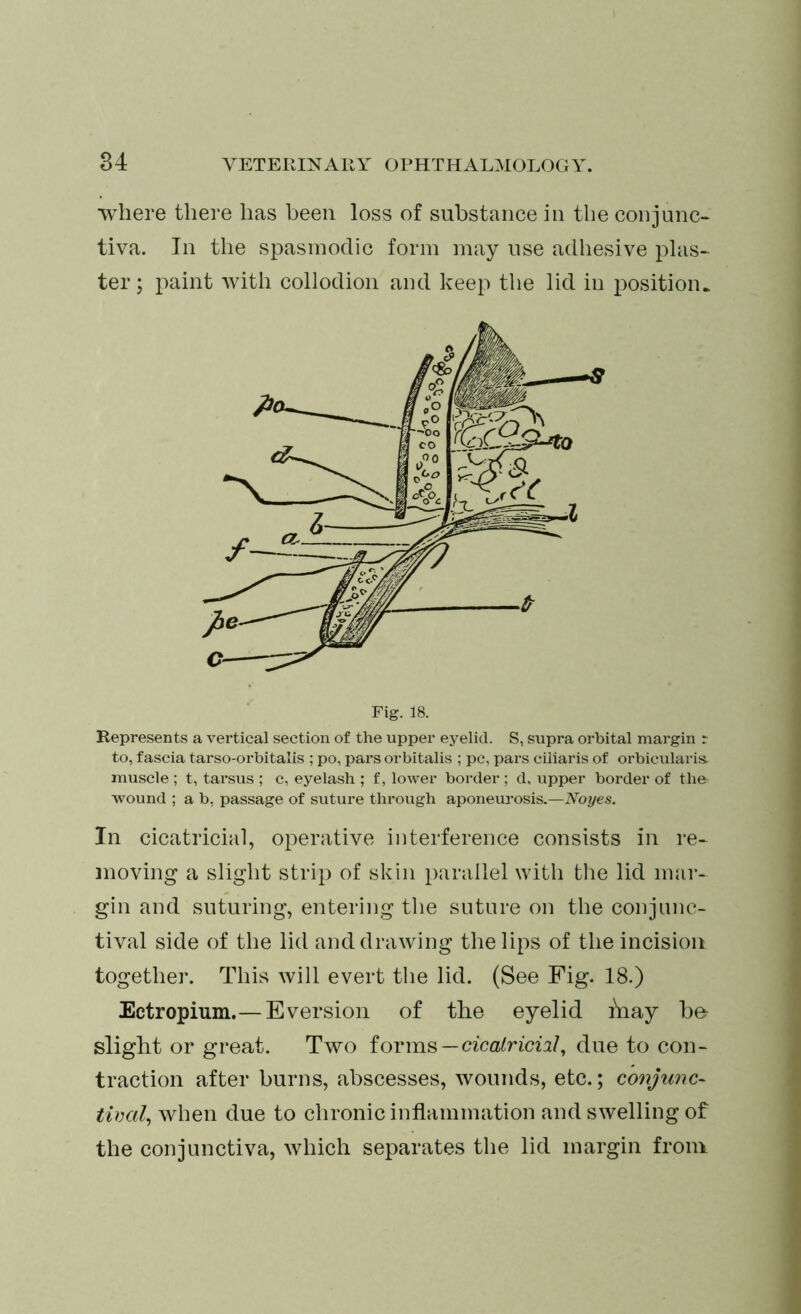 where there has been loss of substance in the conjunc- tiva. In the spasmodic form may use adhesive plas- ter; paint with collodion and keep the lid in position. Fig. 18. Represents a vertical section of the upper eyelid. S, supra orbital margin r to, fascia tarso-orbitalis ; po, pars orbitalis ; pc, pars ciliaris of orbicularis muscle ; t, tarsus ; c, eyelash ; f, lower border ; d, upper border of the wound ; a b, passage of suture through aponeurosis.—Noyes. In cicatricial, operative interference consists in re- moving a slight strip of skin parallel with the lid mar- gin and suturing, entering the suture on the conjunc- tival side of the lid and drawing the lips of the incision together. This will evert the lid. (See Fig. 18.) Ectropium.— Eversion of the eyelid hiay b& slight or great. Two forms—cicalriciil, due to con- traction after burns, abscesses, wounds, etc.; conjunc- tival, when due to chronic inflammation and swelling of the conjunctiva, which separates the lid margin from