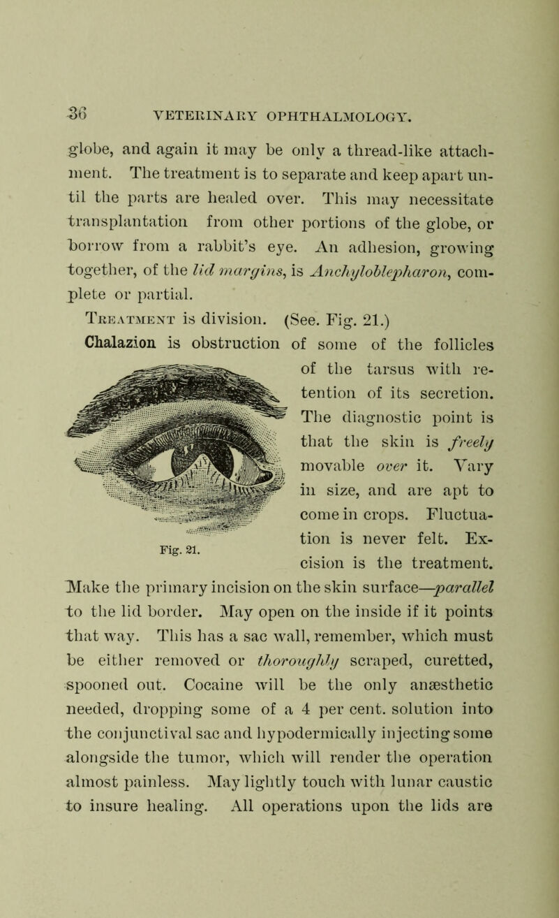 globe, and again it may be only a thread-like attach- ment. The treatment is to separate and keep apart un- til the parts are healed over. This may necessitate transplantation from other portions of the globe, or borrow from a rabbit’s eye. An adhesion, growing together, of the lid margins, is Anchyloblepharon, com- plete or partial. Treatment is division. (See. Fig. 21.) Chalazion is obstruction of some of the follicles Make the primary incision on the skin surface—parallel to the lid border. May open on the inside if it points that way. This has a sac wall, remember, which must be either removed or thoroughly scraped, curetted, spooned out. Cocaine will be the only anaesthetic needed, dropping some of a 4 per cent, solution into the conjunctival sac and hypodermically injecting some alongside the tumor, which will render the operation almost painless. May lightly touch with lunar caustic to insure healing. All operations upon the lids are Fig. 21. of the tarsus with re- tention of its secretion. The diagnostic point is that the skin is freely movable over it. Vary in size, and are apt to come in crops. Fluctua- tion is never felt. Ex- cision is the treatment.