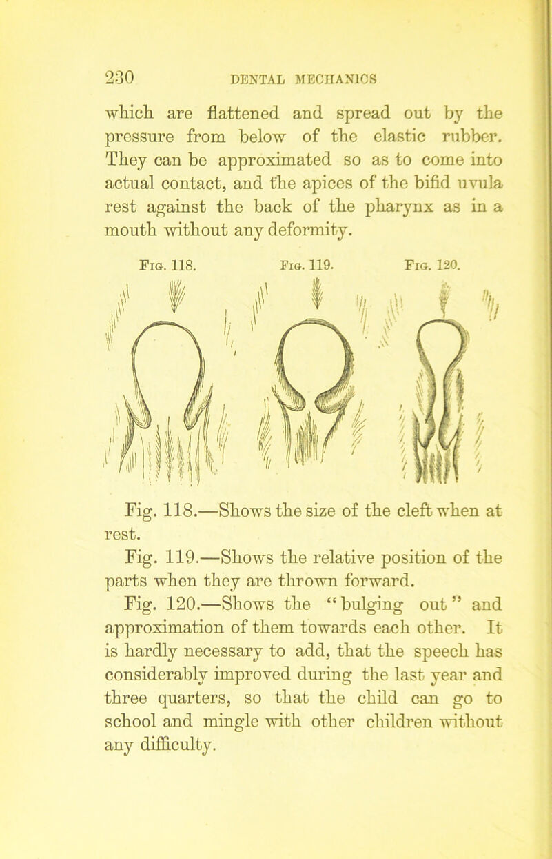 which, are flattened and spread out by the pressure from below of the elastic rubber. They can be approximated so as to come into actual contact, and the apices of the bifid uvula rest against the back of the pharynx as in a mouth without any deformity. Fig. 118. Fig. 119. Fig. 120. rest. Fig. 119.—Shows the relative position of the parts when they are thrown forward. Fig. 120.—Shows the “bulging out” and approximation of them towards each other. It is hardly necessary to add, that the speech has considerably improved during the last year and three quarters, so that the child can go to school and mingle with other children without any difficulty.